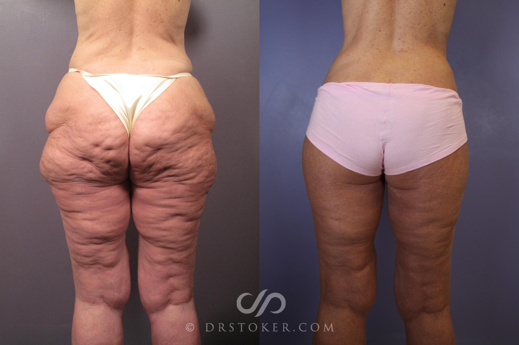 Before & After After Weight Loss Case 1493 View #1 View in Los Angeles, CA