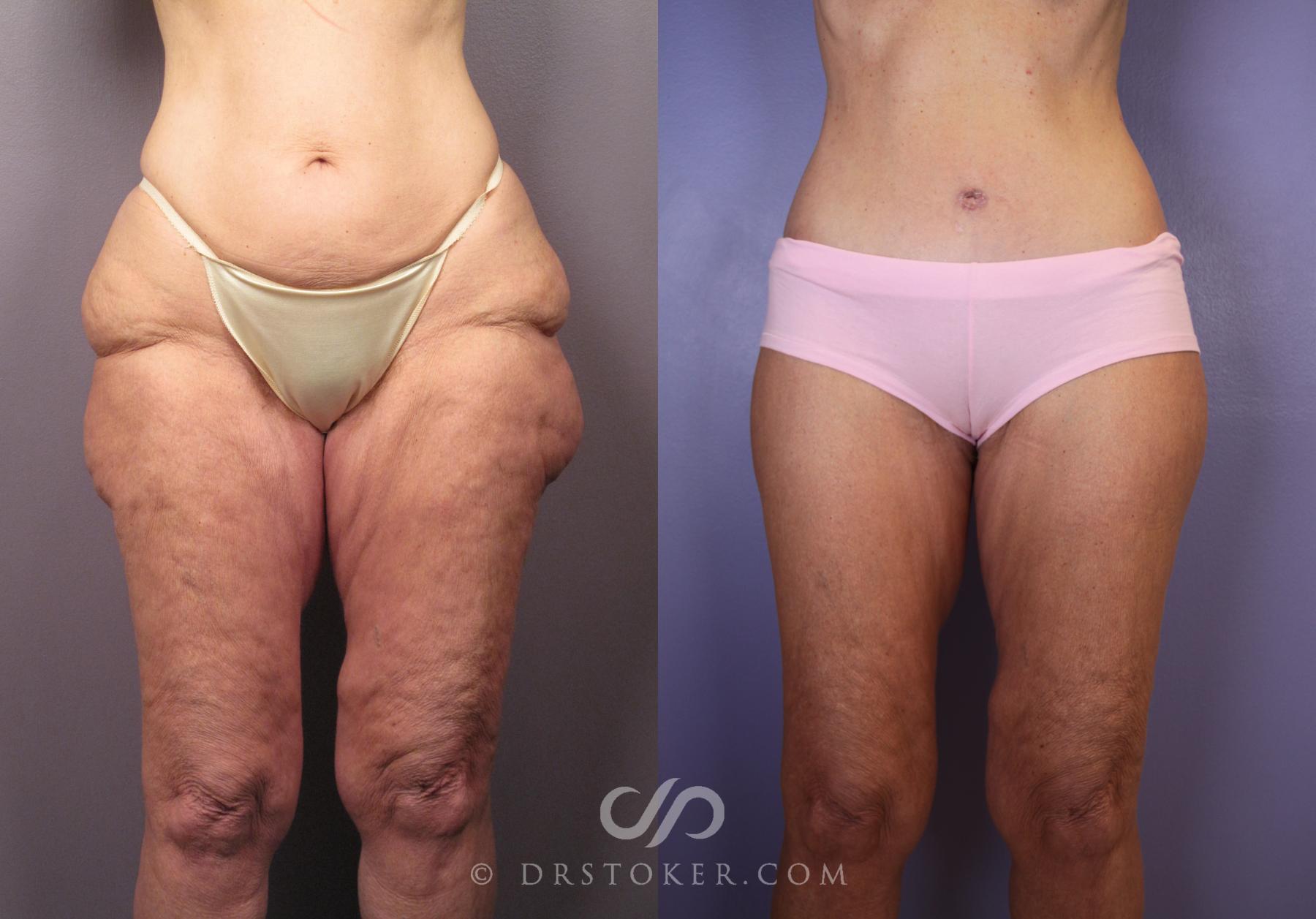 Before & After After Weight Loss Case 1493 View #2 View in Los Angeles, CA
