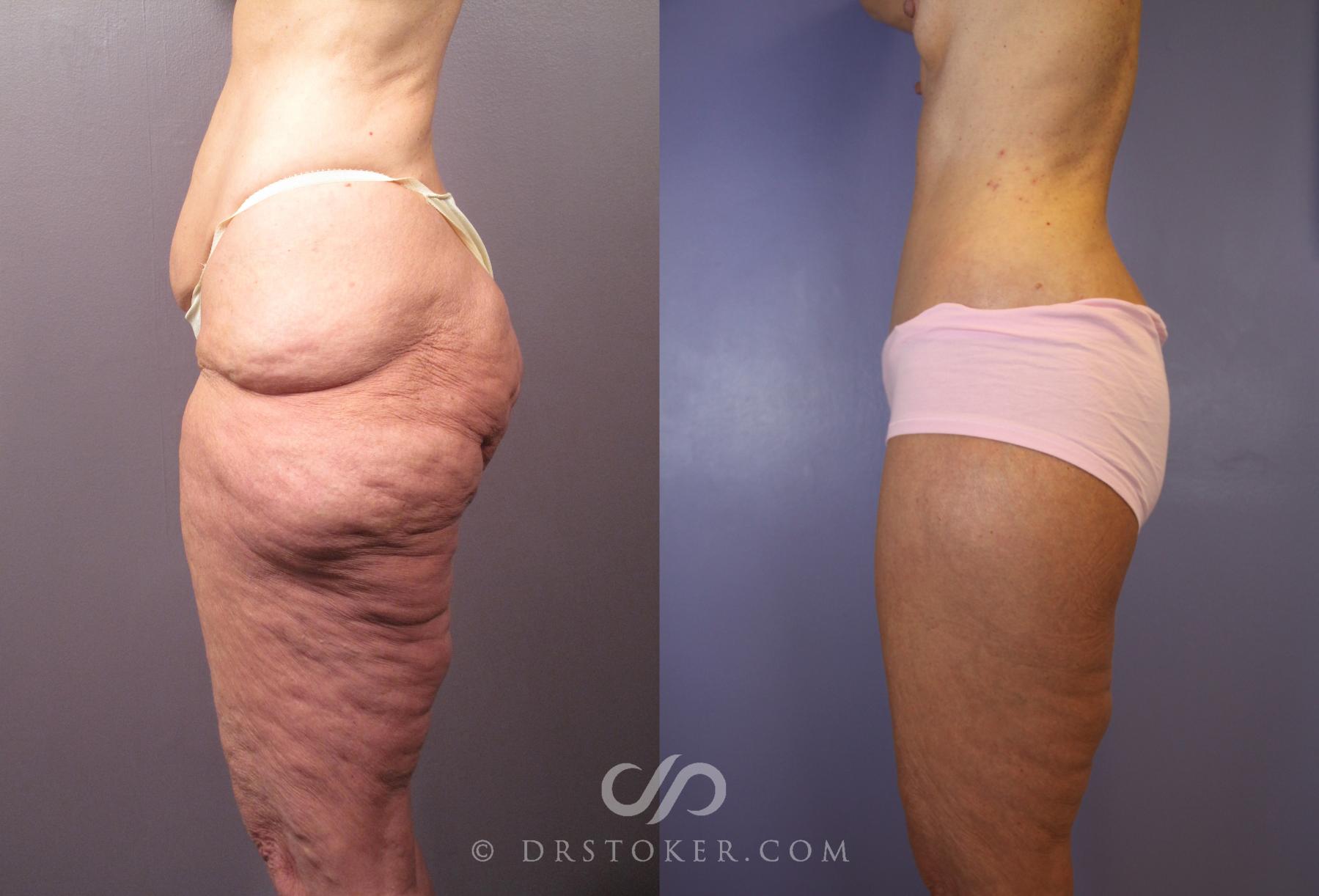 Before & After After Weight Loss Case 1493 View #3 View in Los Angeles, CA