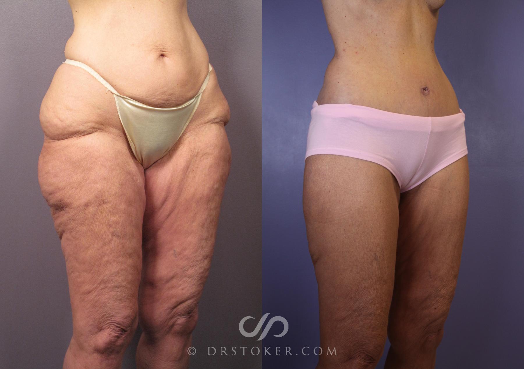 Before & After After Weight Loss Case 1493 View #4 View in Los Angeles, CA