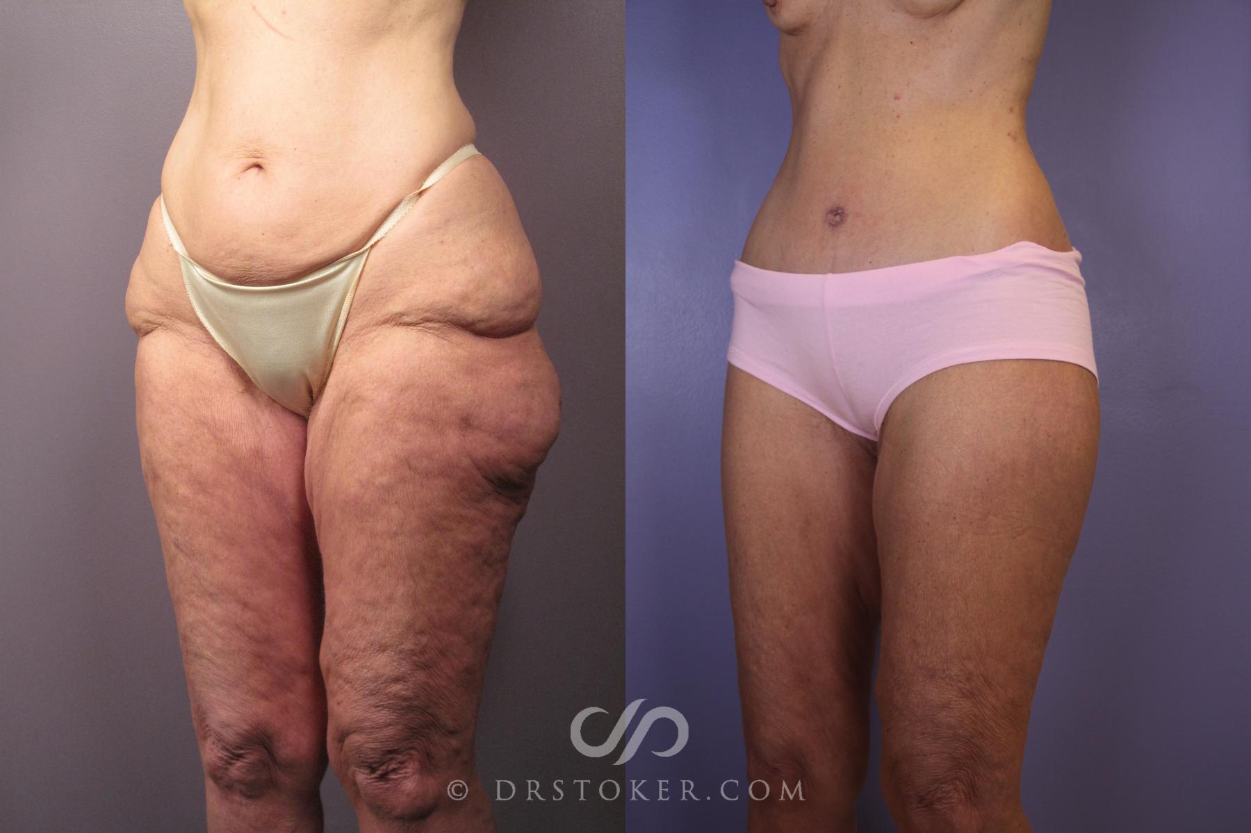 Before & After After Weight Loss Case 1493 View #5 View in Los Angeles, CA