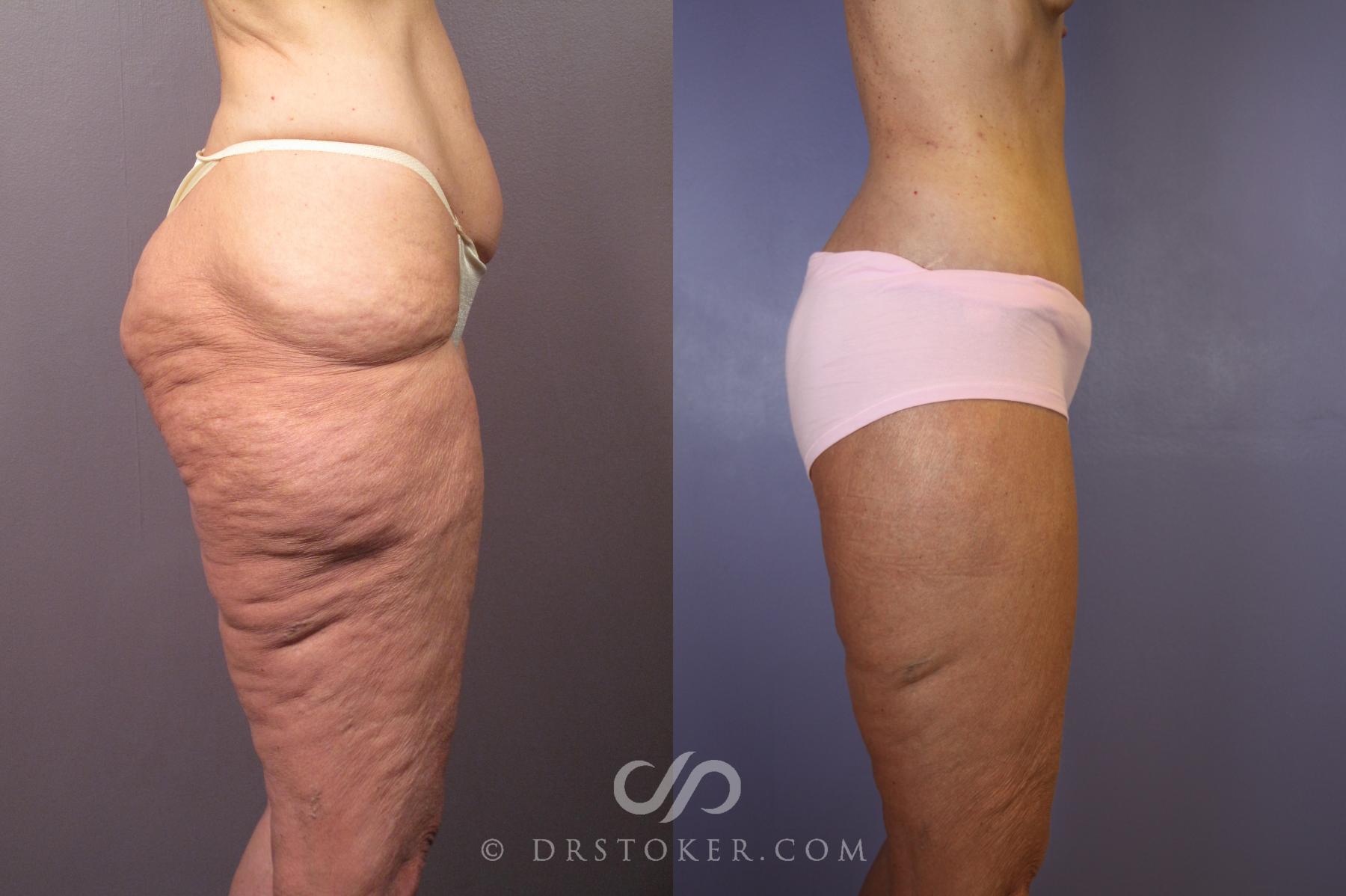 Before & After After Weight Loss Case 1493 View #6 View in Los Angeles, CA
