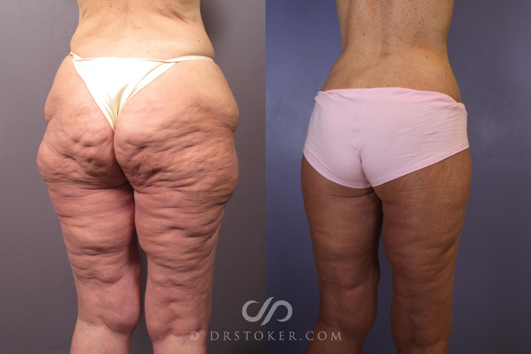 Before & After After Weight Loss Case 1493 View #7 View in Los Angeles, CA