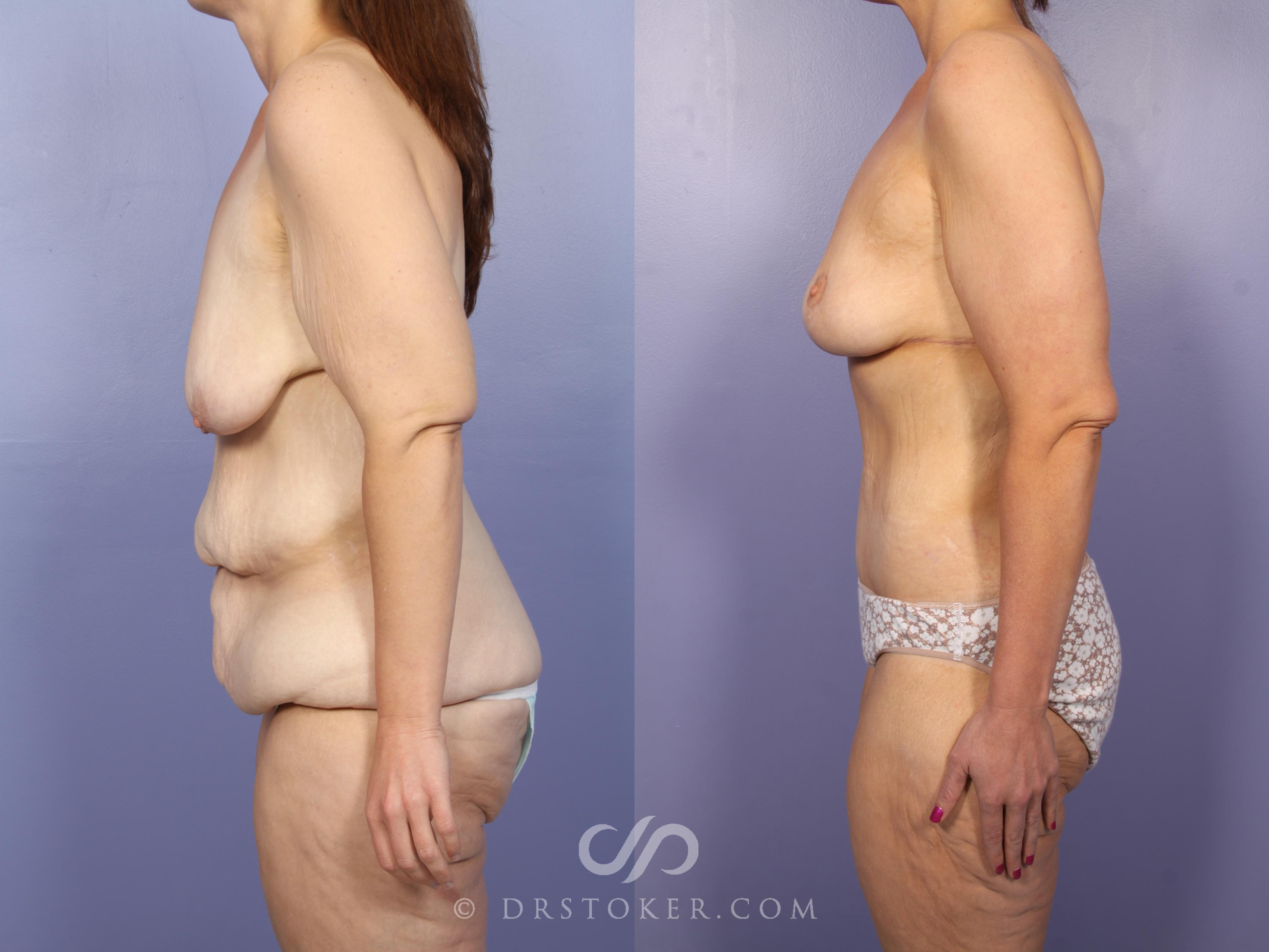Before & After Thigh lift Case 1660 View #1 View in Los Angeles, CA