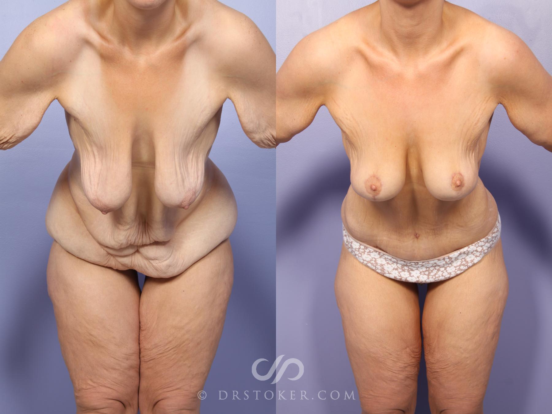 Before & After After Weight Loss Case 1661 View #1 View in Los Angeles, CA