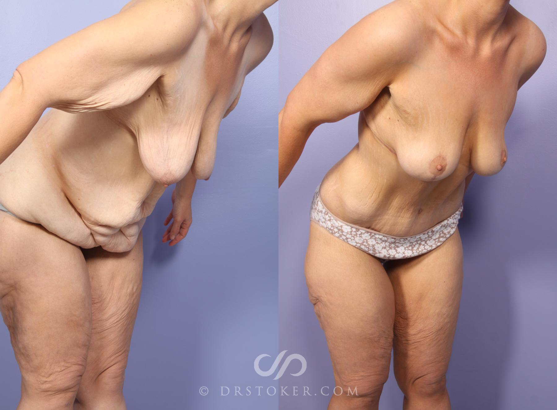Before & After After Weight Loss Case 1662 View #1 View in Los Angeles, CA