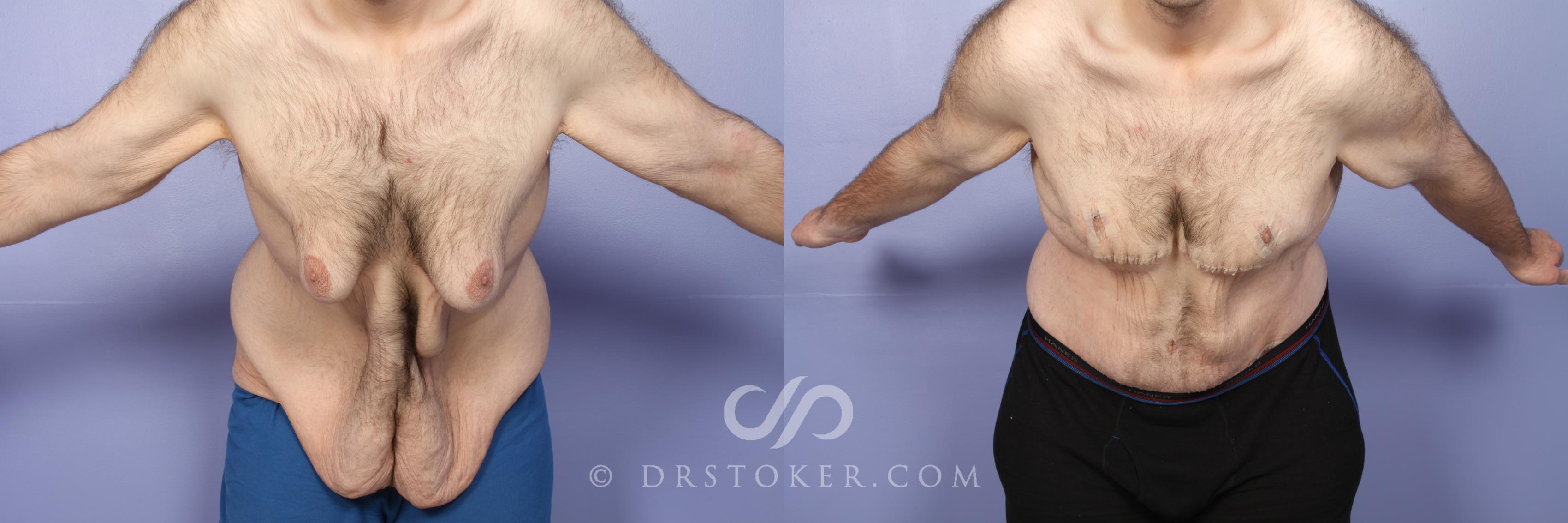 Before & After Tummy Tuck for Men Case 1663 View #1 View in Los Angeles, CA
