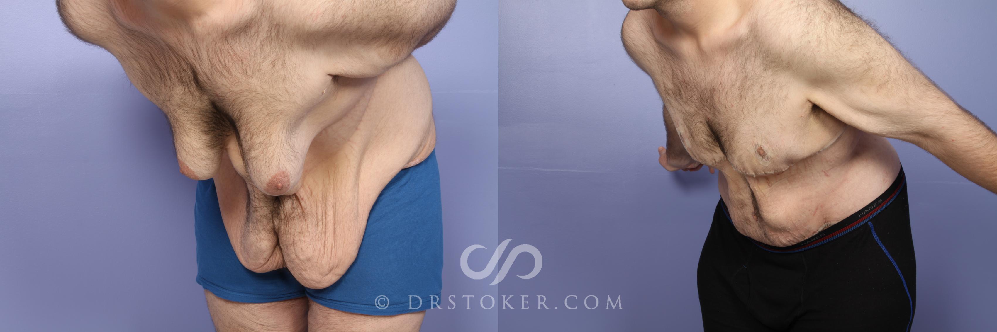 Before & After Tummy Tuck for Men Case 1664 View #1 View in Los Angeles, CA