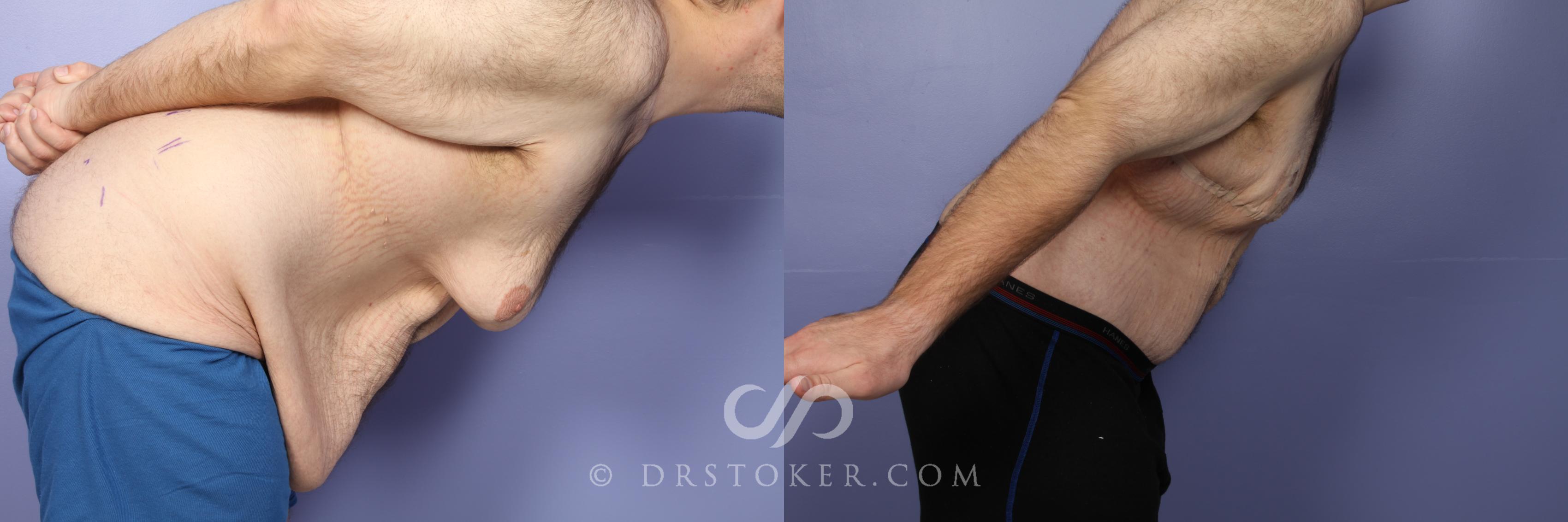Before & After Tummy Tuck for Men Case 1665 View #1 View in Los Angeles, CA