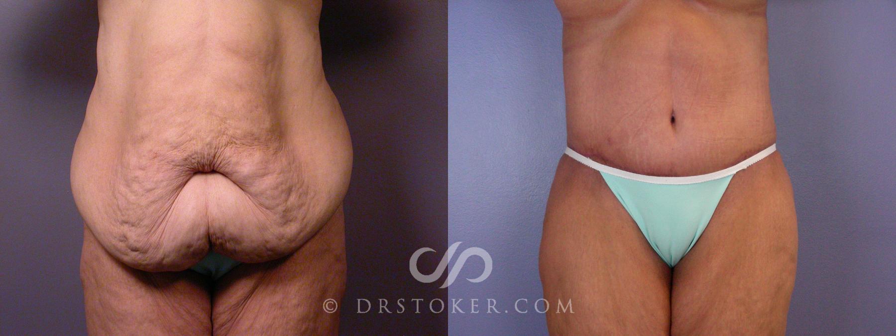 Before & After After Weight Loss Case 1666 View #1 View in Los Angeles, CA