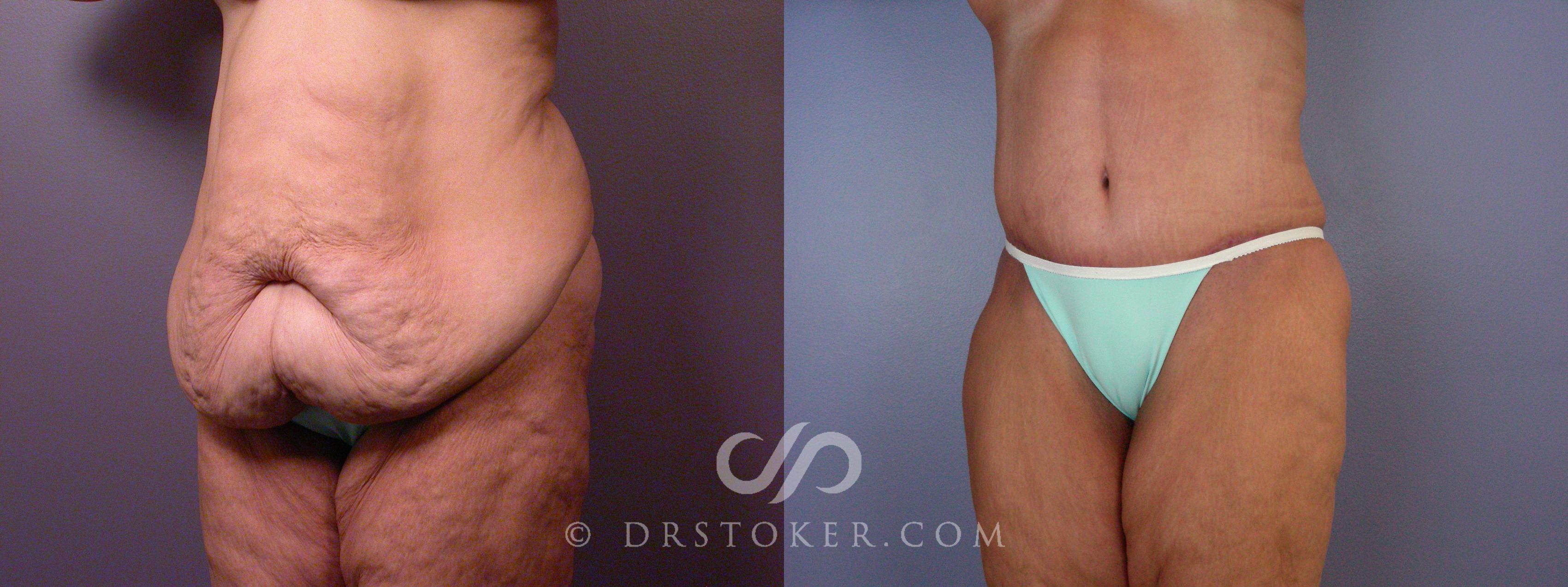 Before & After Tummy Tuck Case 1667 View #1 View in Los Angeles, CA