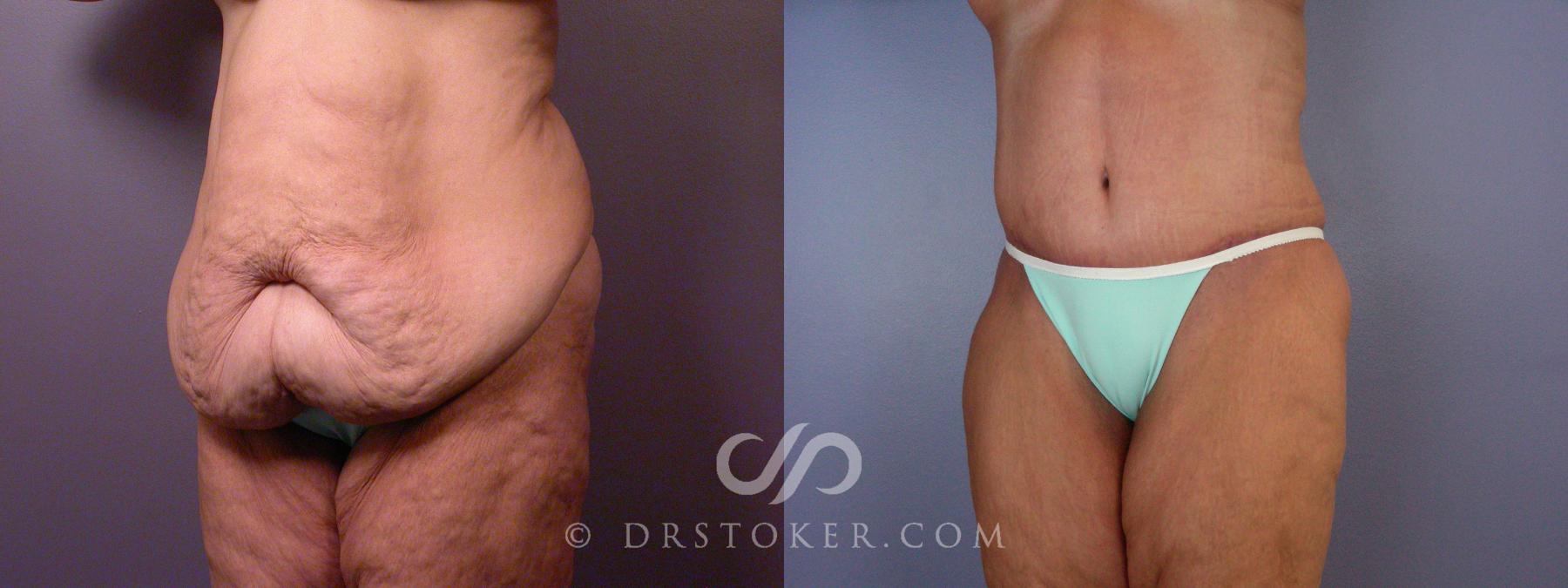 Before & After Tummy Tuck Case 1667 View #1 View in Los Angeles, CA