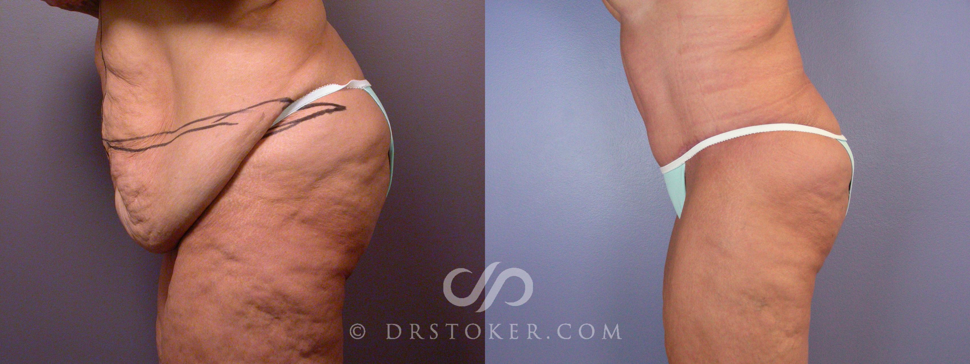 Before & After Tummy Tuck Case 1668 View #1 View in Los Angeles, CA