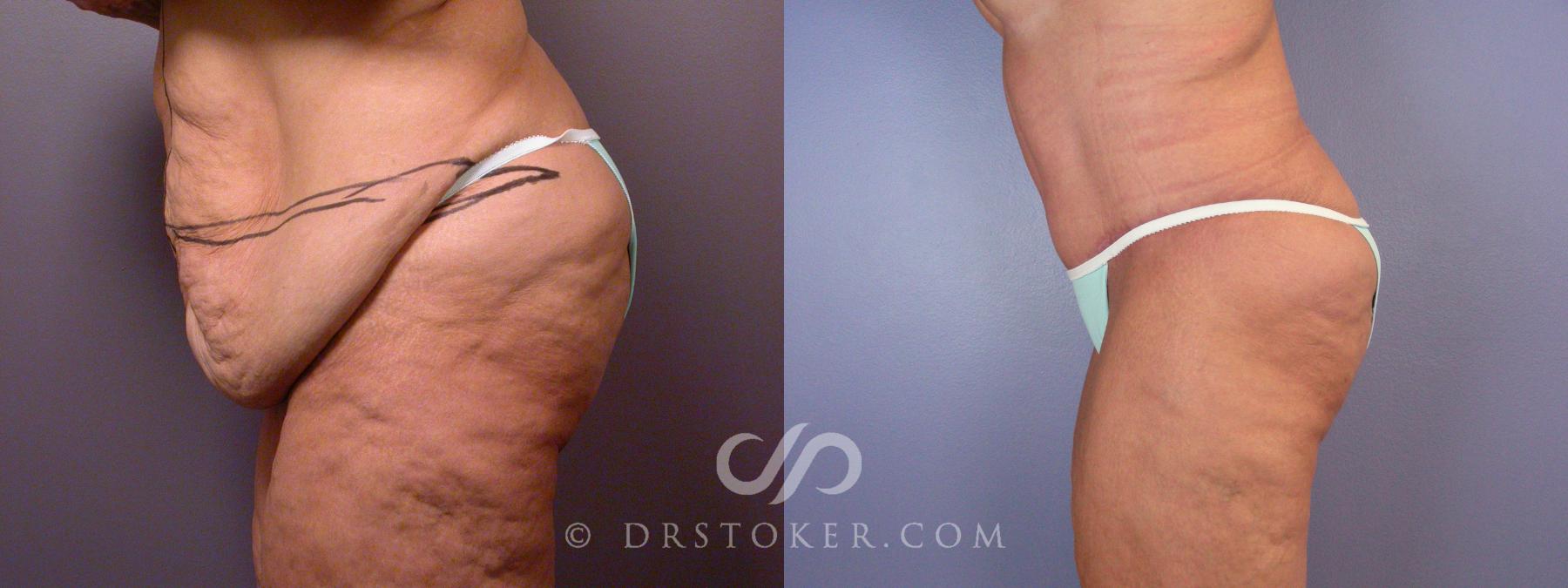 Before & After After Weight Loss Case 1668 View #1 View in Los Angeles, CA