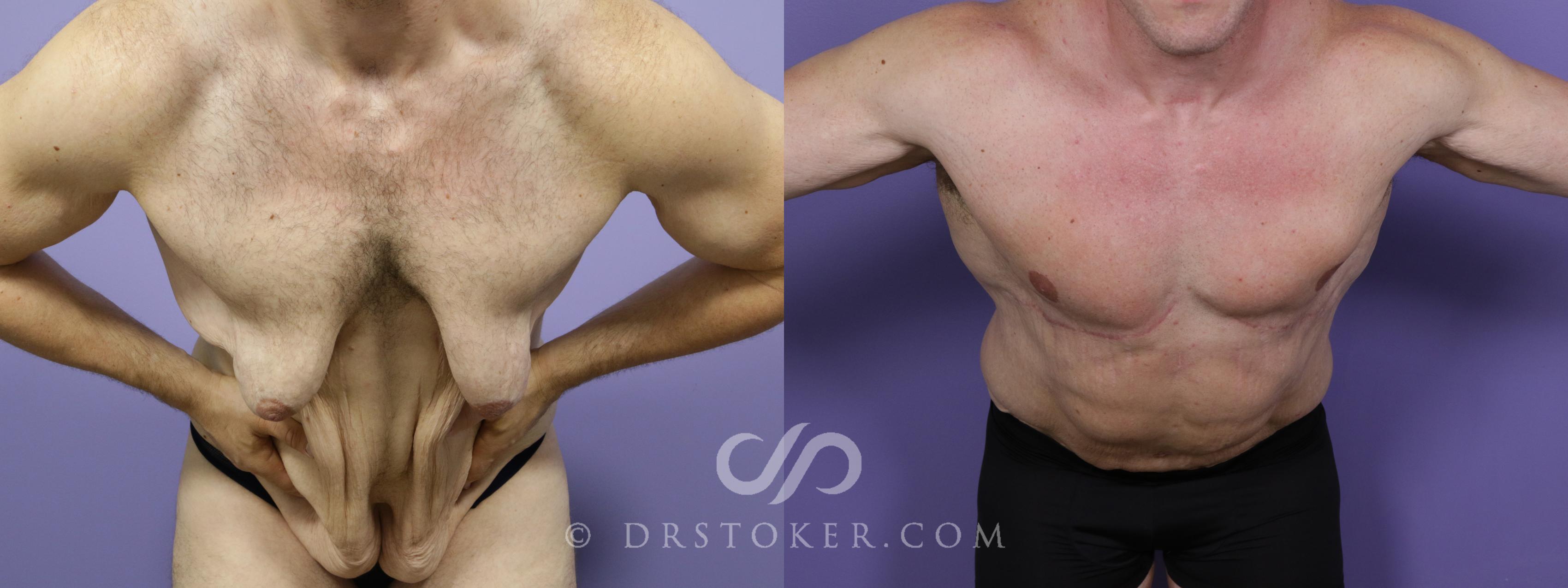 Before & After Tummy Tuck Case 1718 View #1 View in Los Angeles, CA