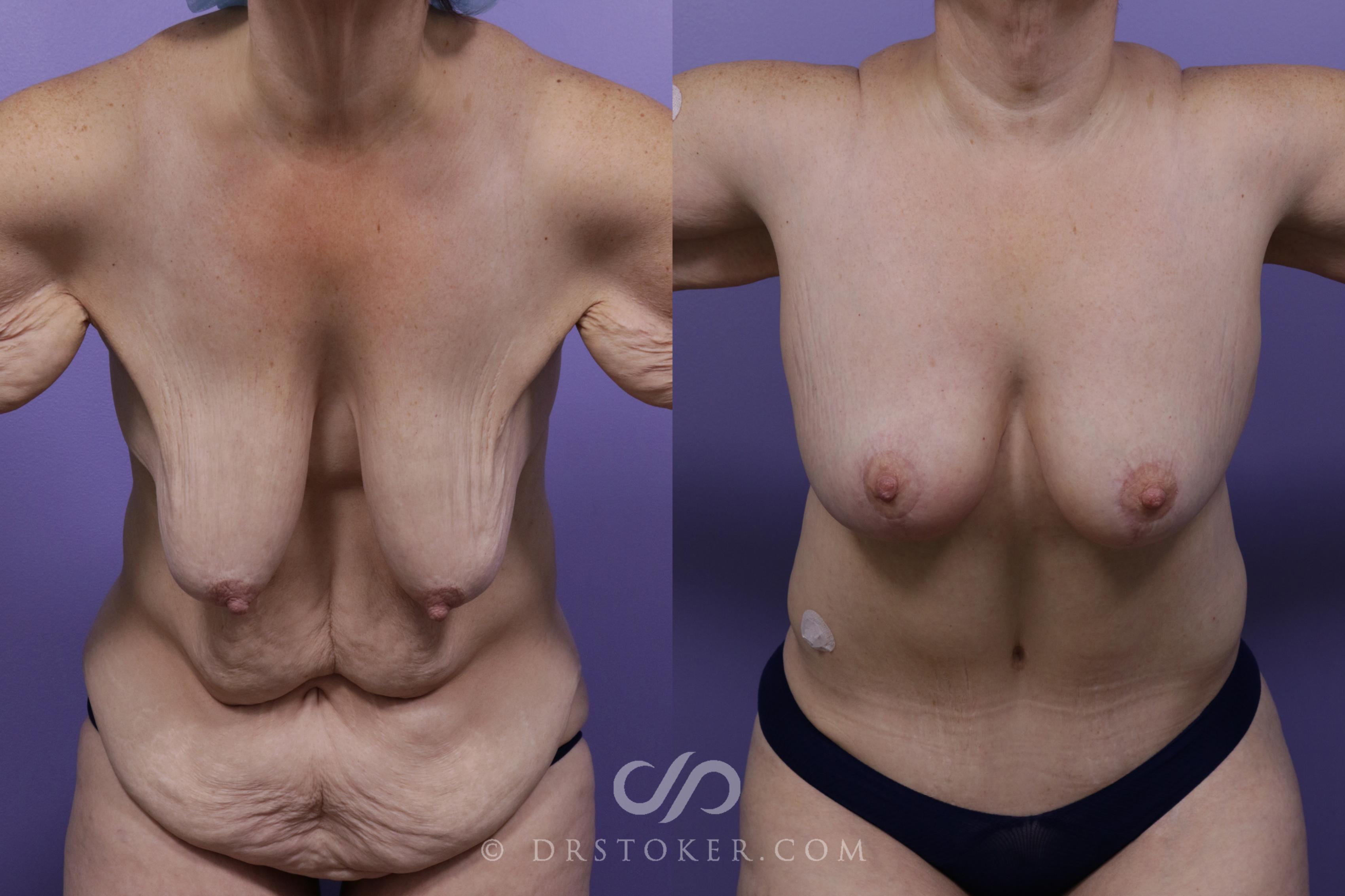 Before & After After Weight Loss Case 1726 View #1 View in Marina del Rey, CA