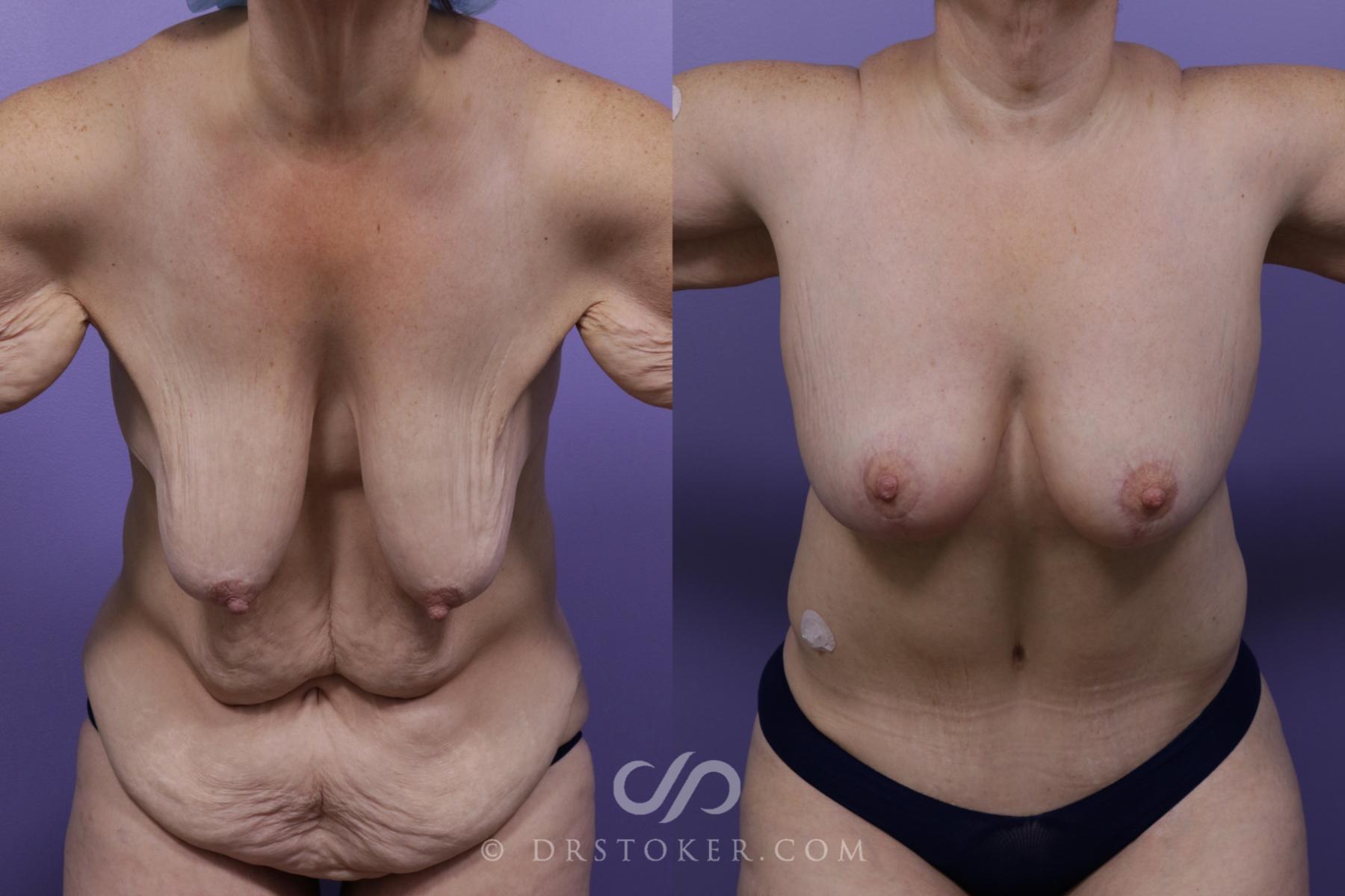 Before & After After Weight Loss Case 1726 View #1 View in Los Angeles, CA