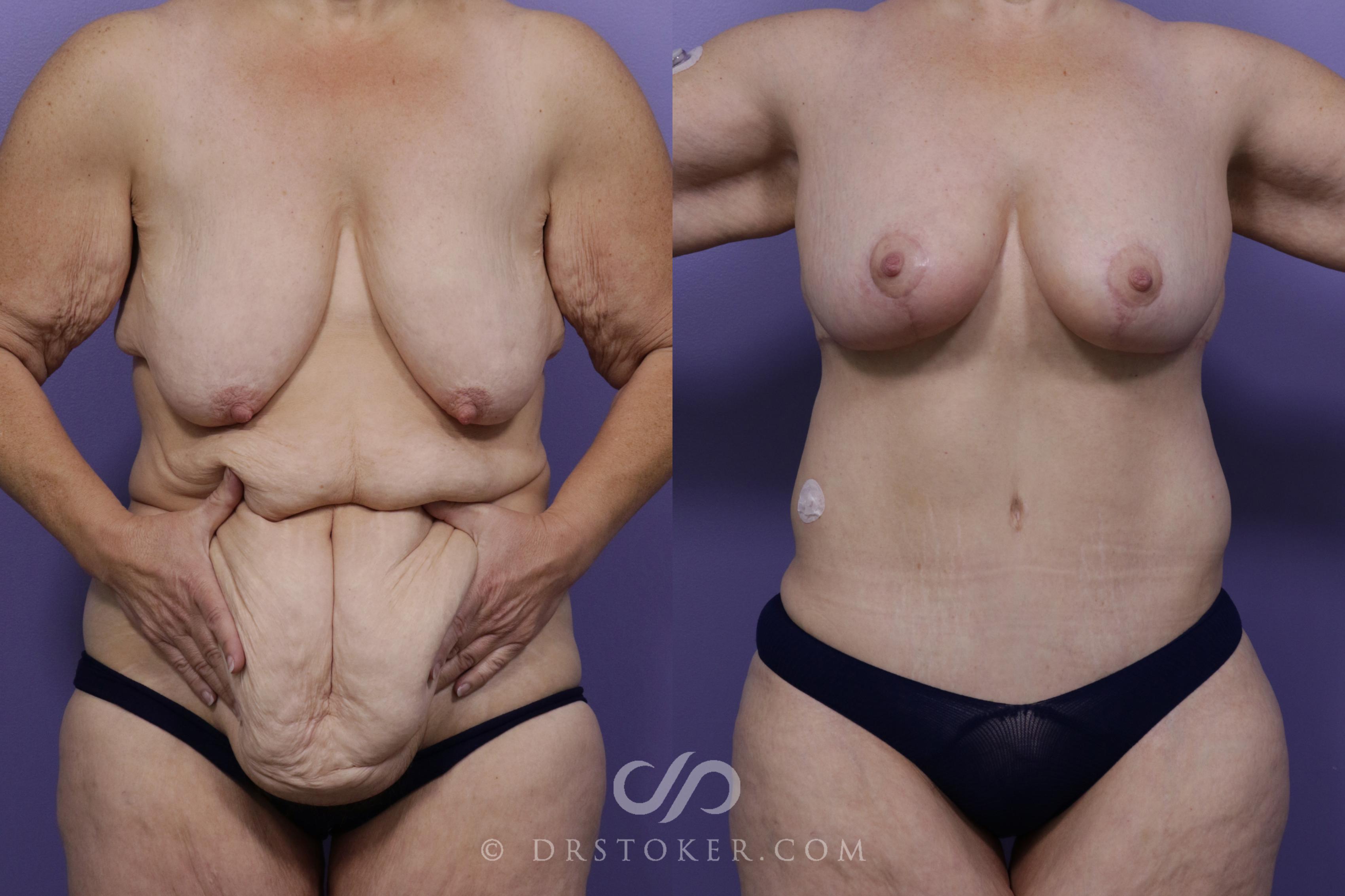 Before & After After Weight Loss Case 1727 View #1 View in Los Angeles, CA