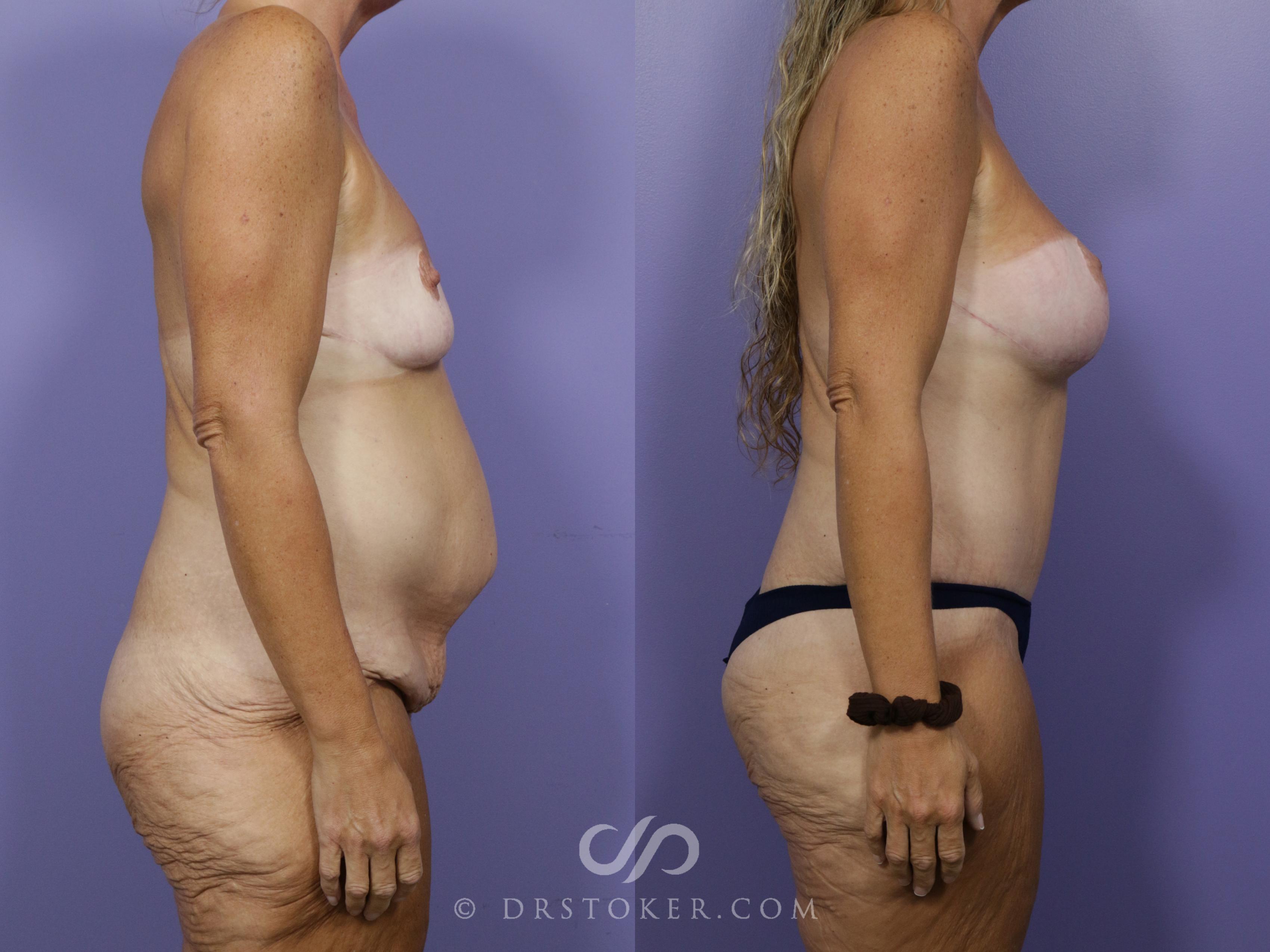 Before & After After Weight Loss Case 1760 View #1 View in Los Angeles, CA