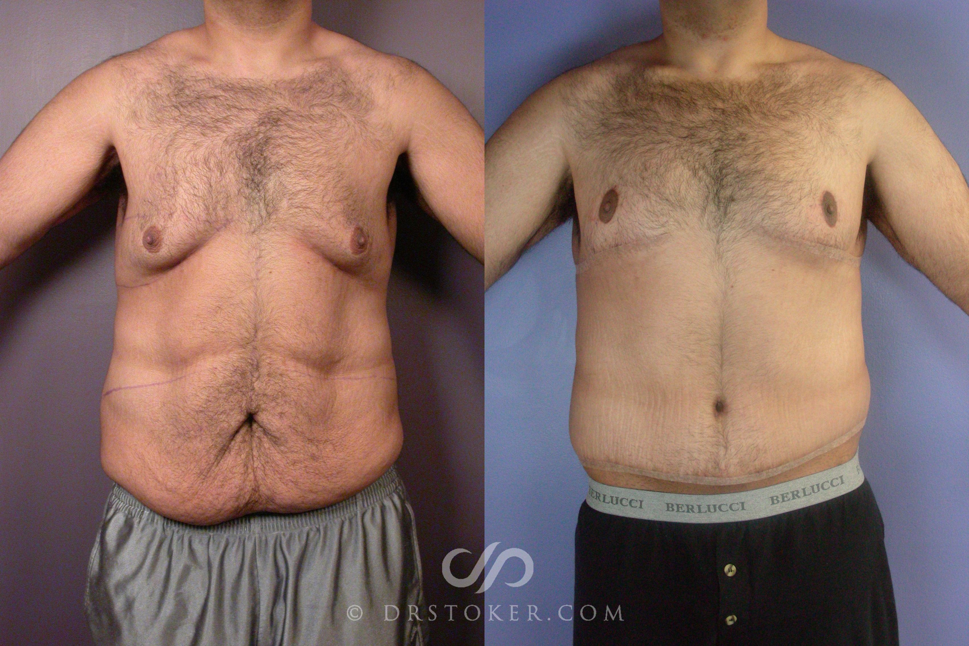 Before & After After Weight Loss Case 1761 Front View in Los Angeles, CA
