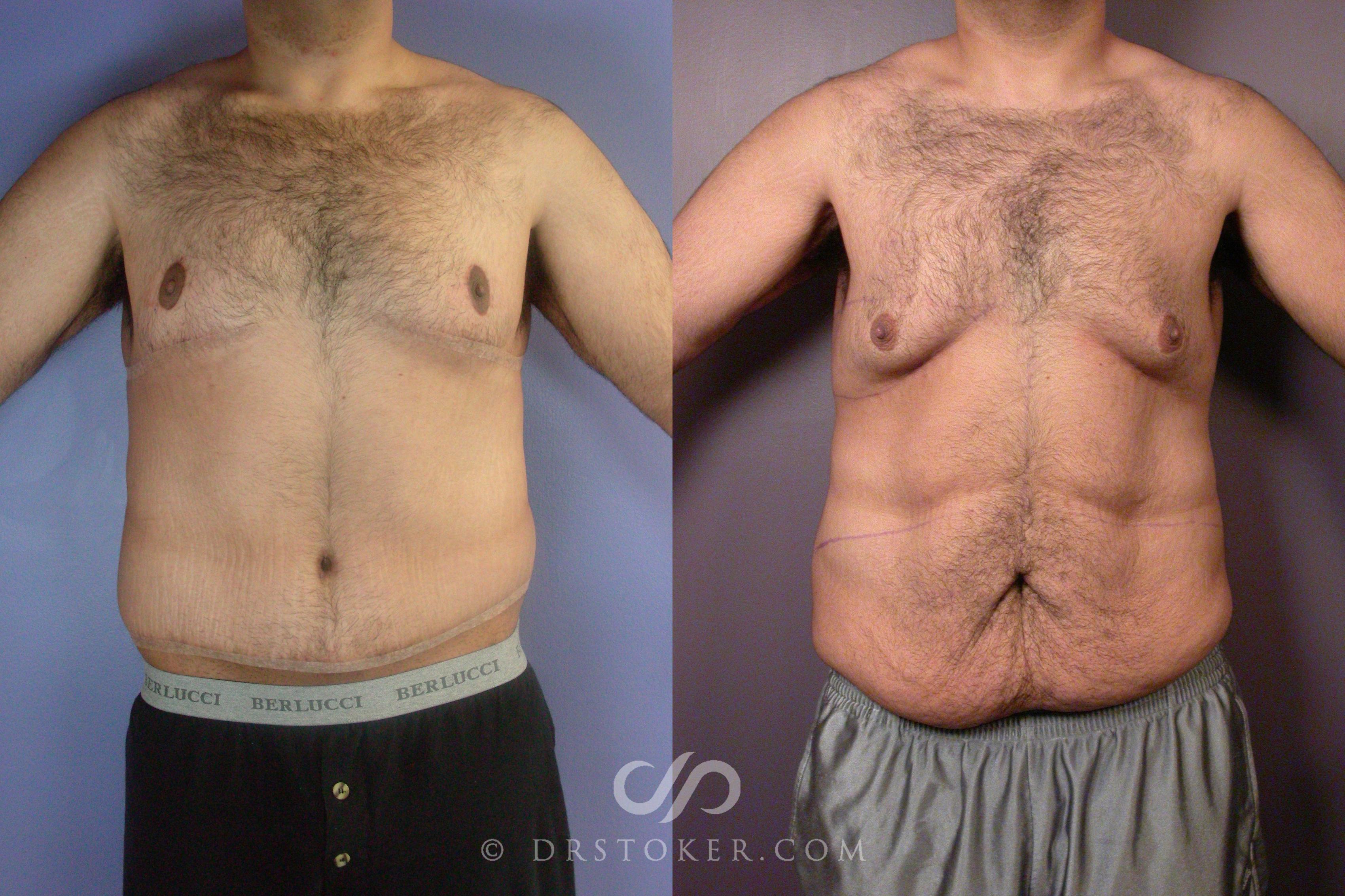 Before & After Tummy Tuck for Men Case 1761 View #1 View in Los Angeles, CA