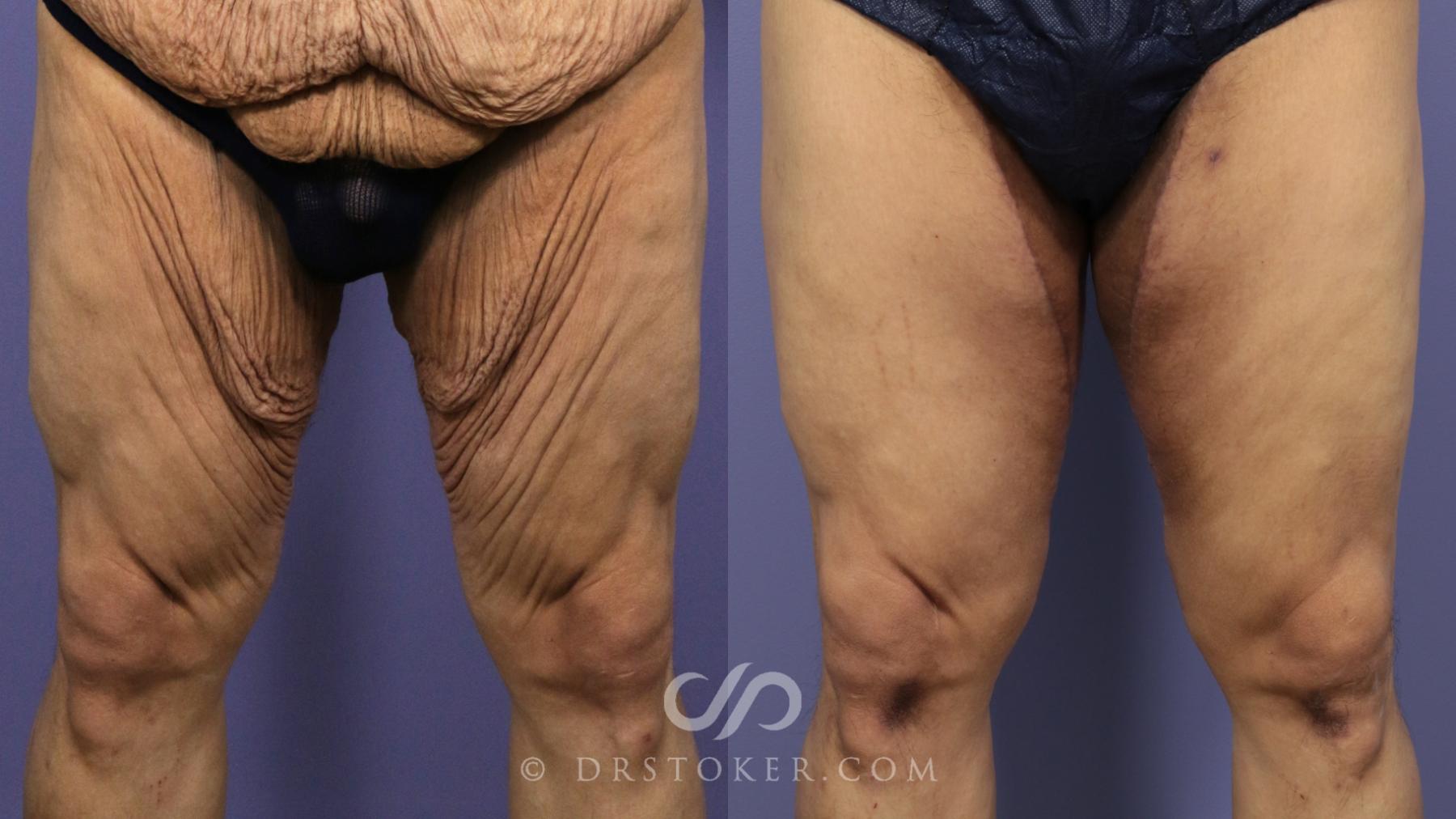 Before & After After Weight Loss Case 1813 Front View in Los Angeles, CA
