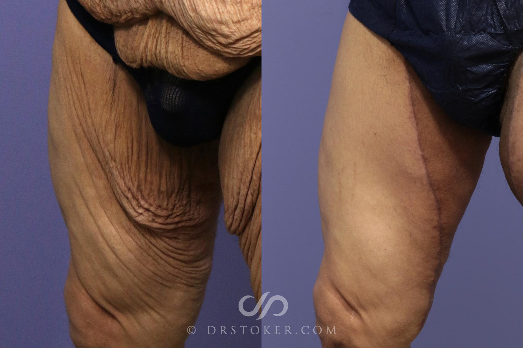 Before & After After Weight Loss Case 1815 Left Oblique View in Los Angeles, CA
