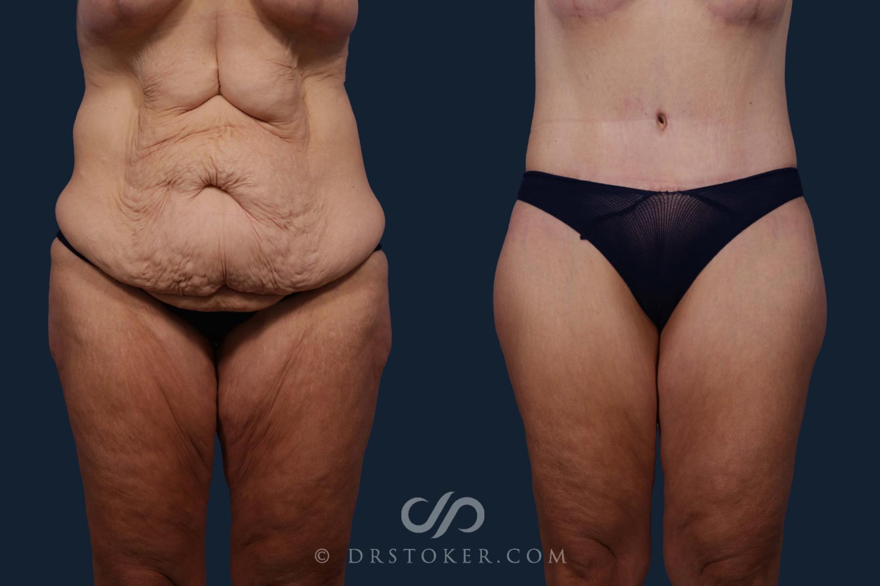 Before & After After Weight Loss Case 1923 Front View in Los Angeles, CA
