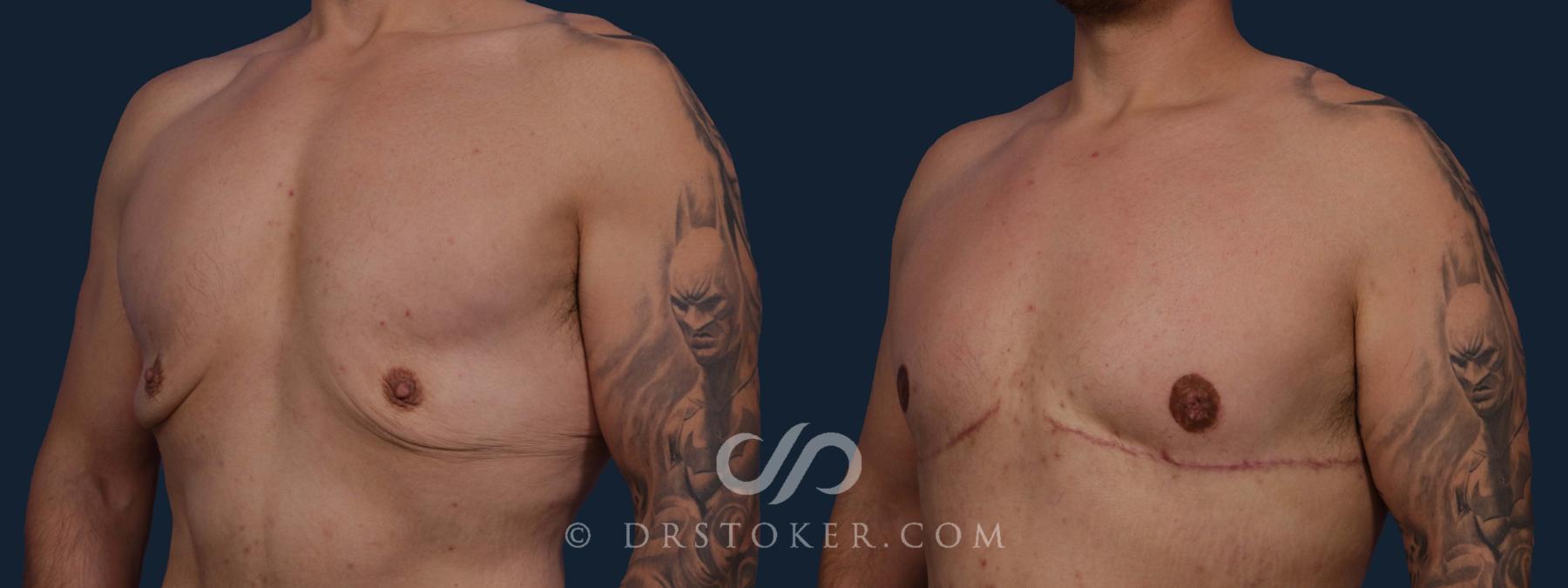 Before & After After Weight Loss Case 1943 Left Oblique View in Los Angeles, CA