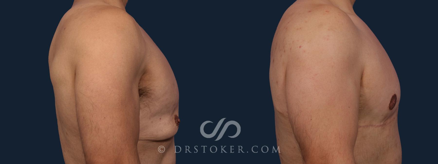 Before & After After Weight Loss Case 1943 Right Side View in Los Angeles, CA
