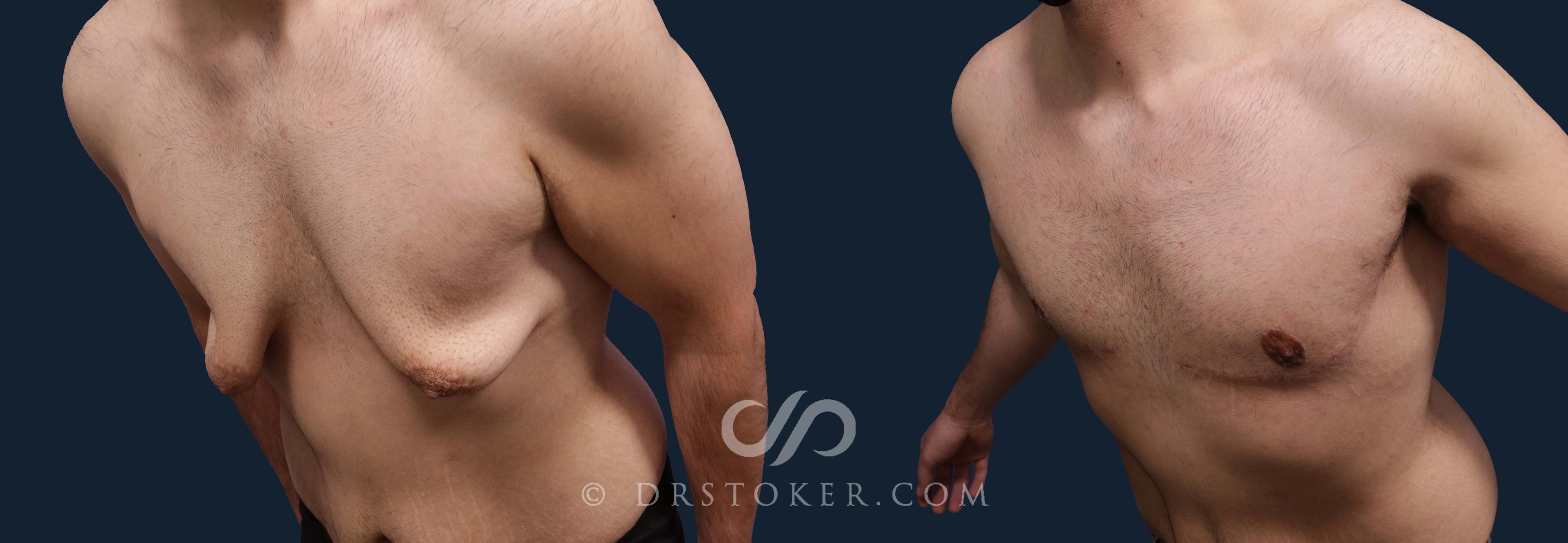 Before & After After Weight Loss Case 2019 Left Oblique View in Los Angeles, CA