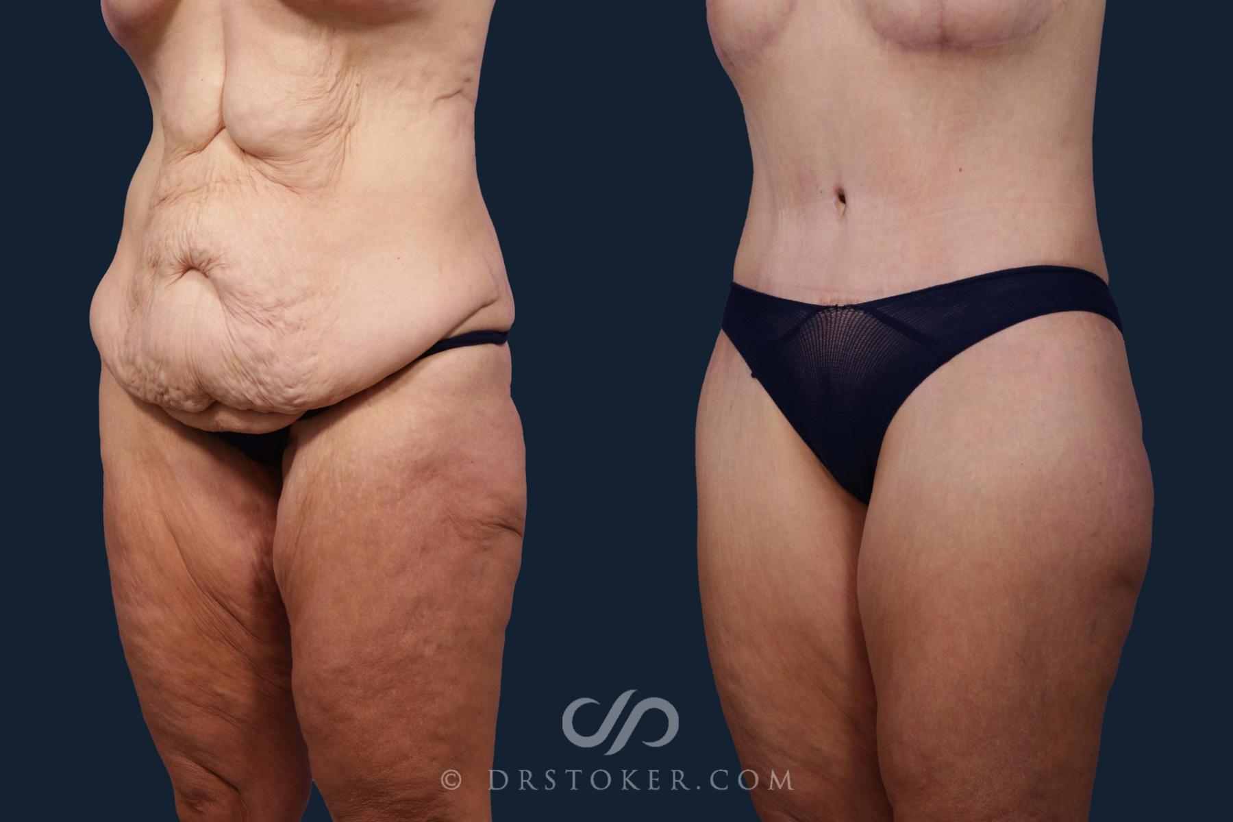 Before & After After Weight Loss Case 2088 Left Oblique View in Los Angeles, CA