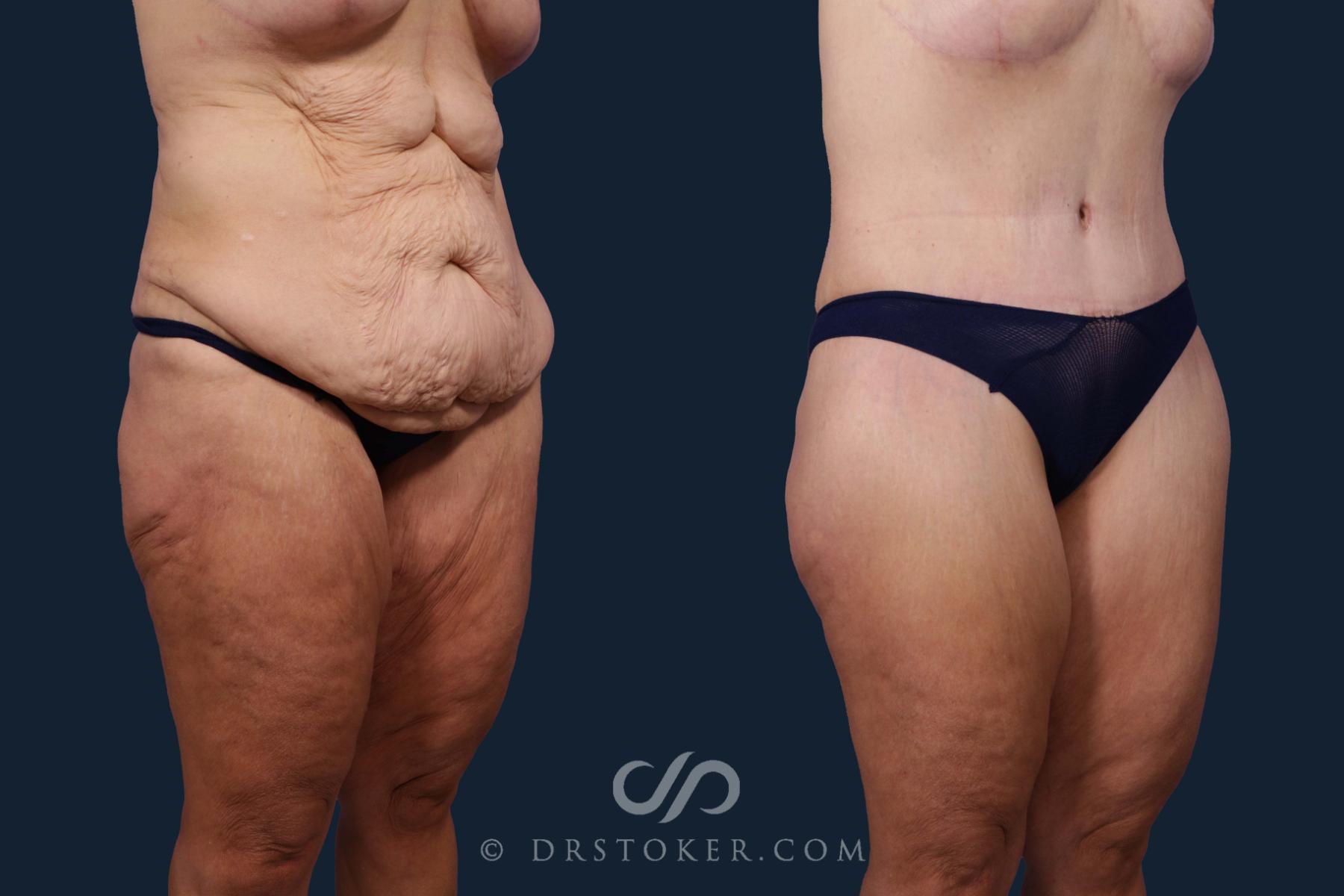 Before & After Tummy Tuck Case 2088 Right Oblique View in Los Angeles, CA