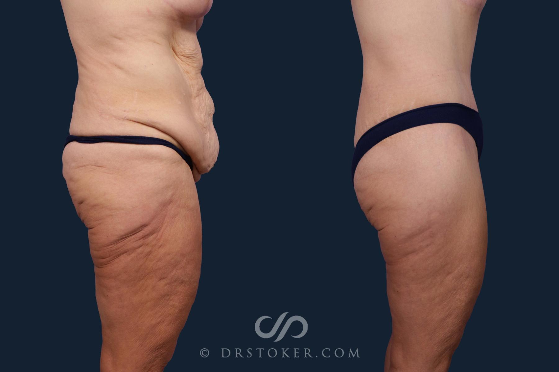 Before & After Tummy Tuck Case 2088 Right Side View in Los Angeles, CA