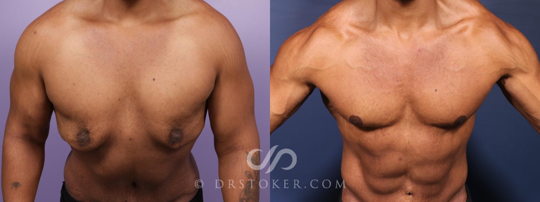 Before & After After Weight Loss Case 2617 Chest Lean View in Los Angeles, CA