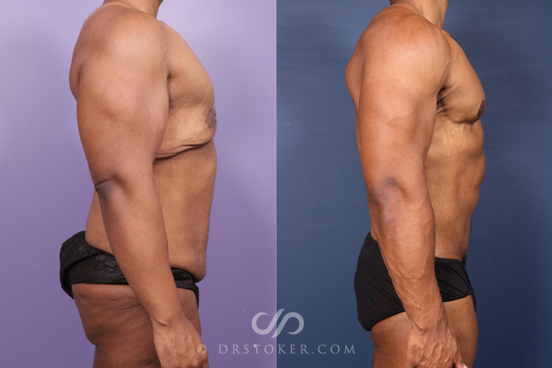 Before & After After Weight Loss Case 2617 Left Side View in Los Angeles, CA