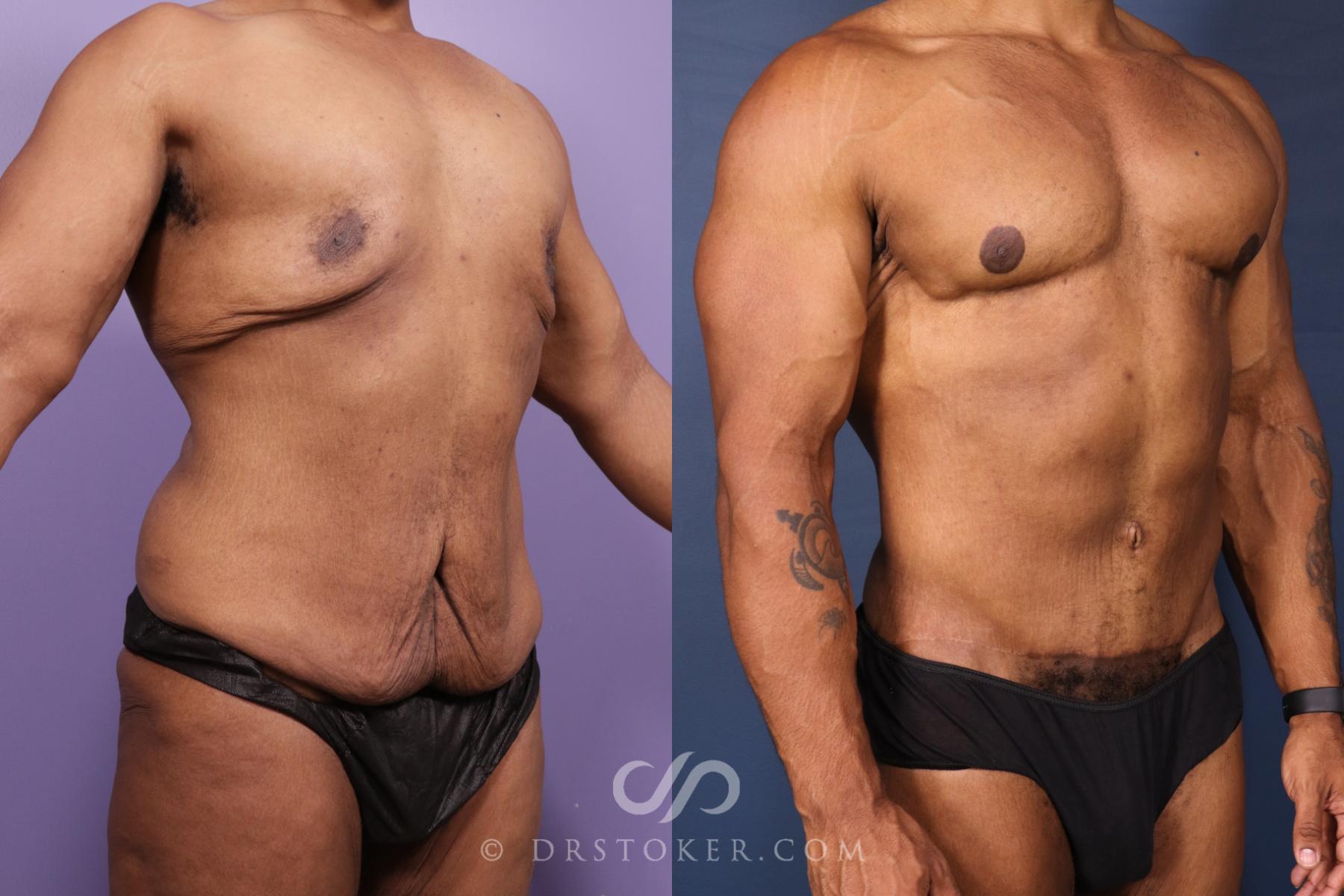 Before & After After Weight Loss Case 2617 Right Oblique View in Los Angeles, CA