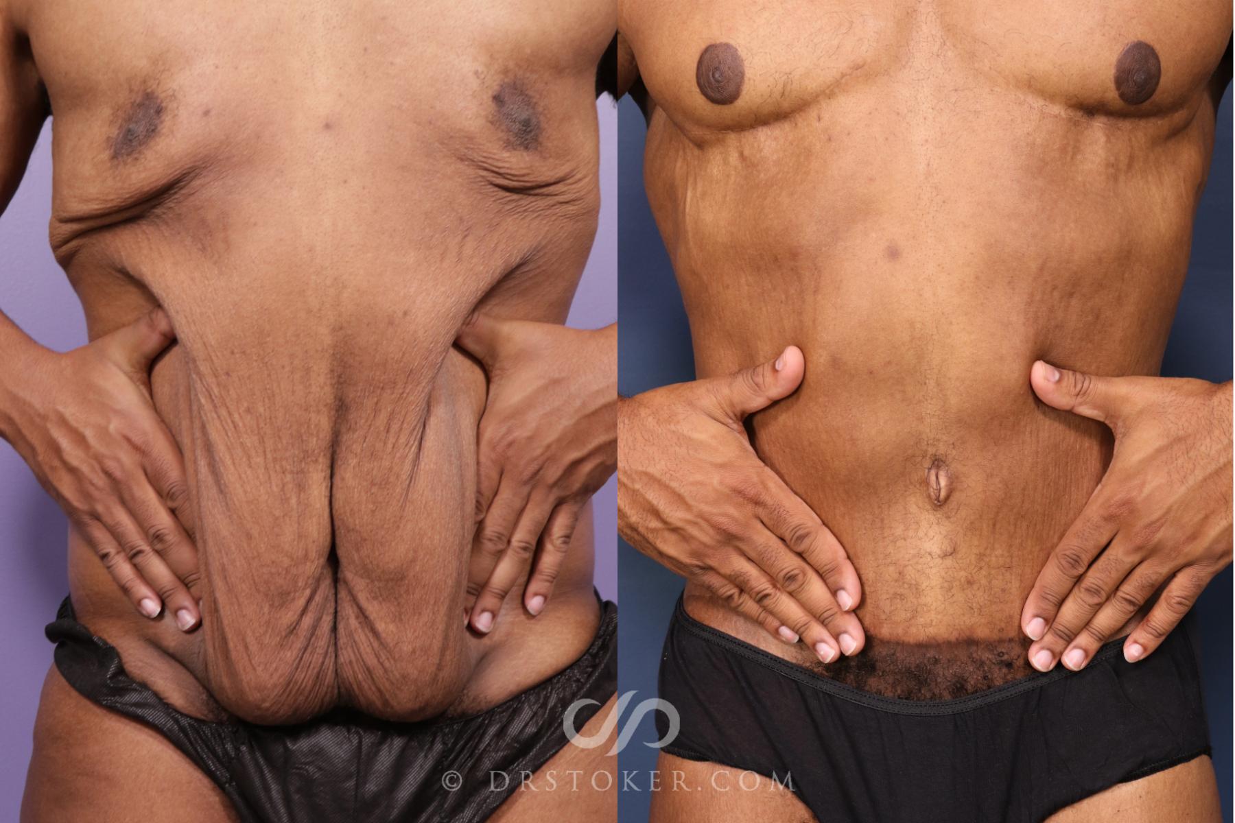 Before & After After Weight Loss Case 2617 Tight Abdomen View in Los Angeles, CA