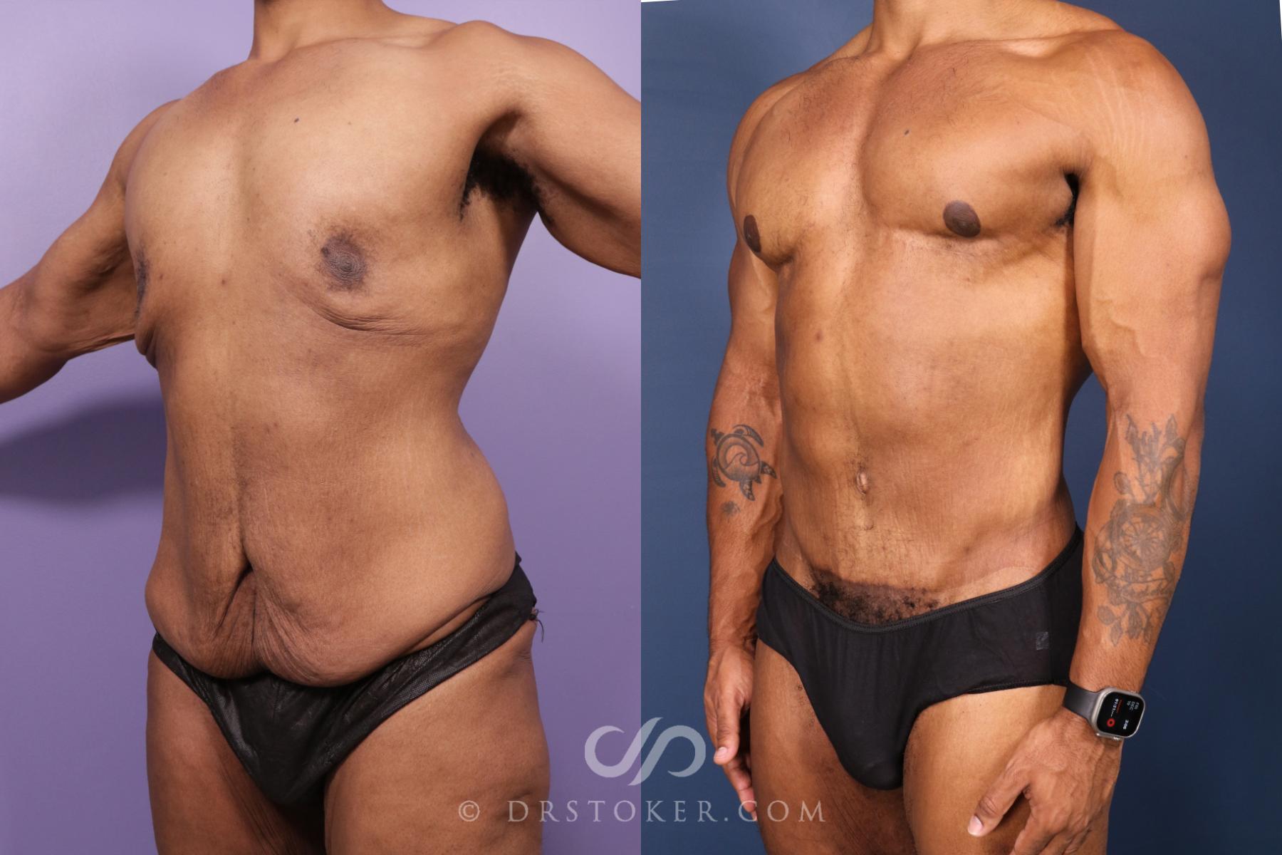 Before & After After Weight Loss Case 2629 Left Oblique View in Los Angeles, CA