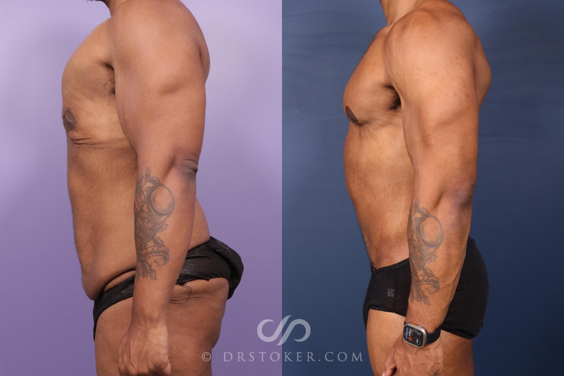 Before & After After Weight Loss Case 2629 Left Side View in Los Angeles, CA