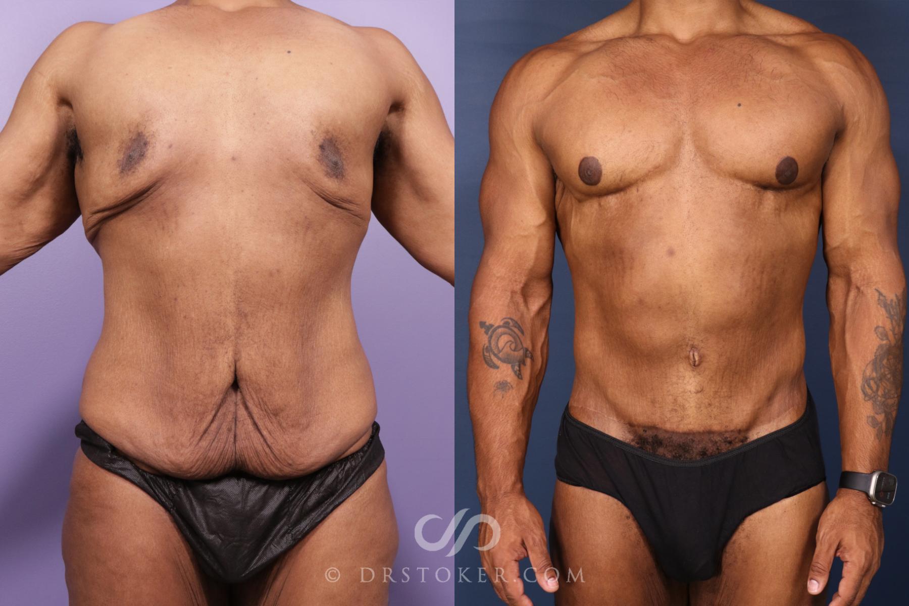 Before & After After Weight Loss Case 2630 Frontal View View in Los Angeles, CA