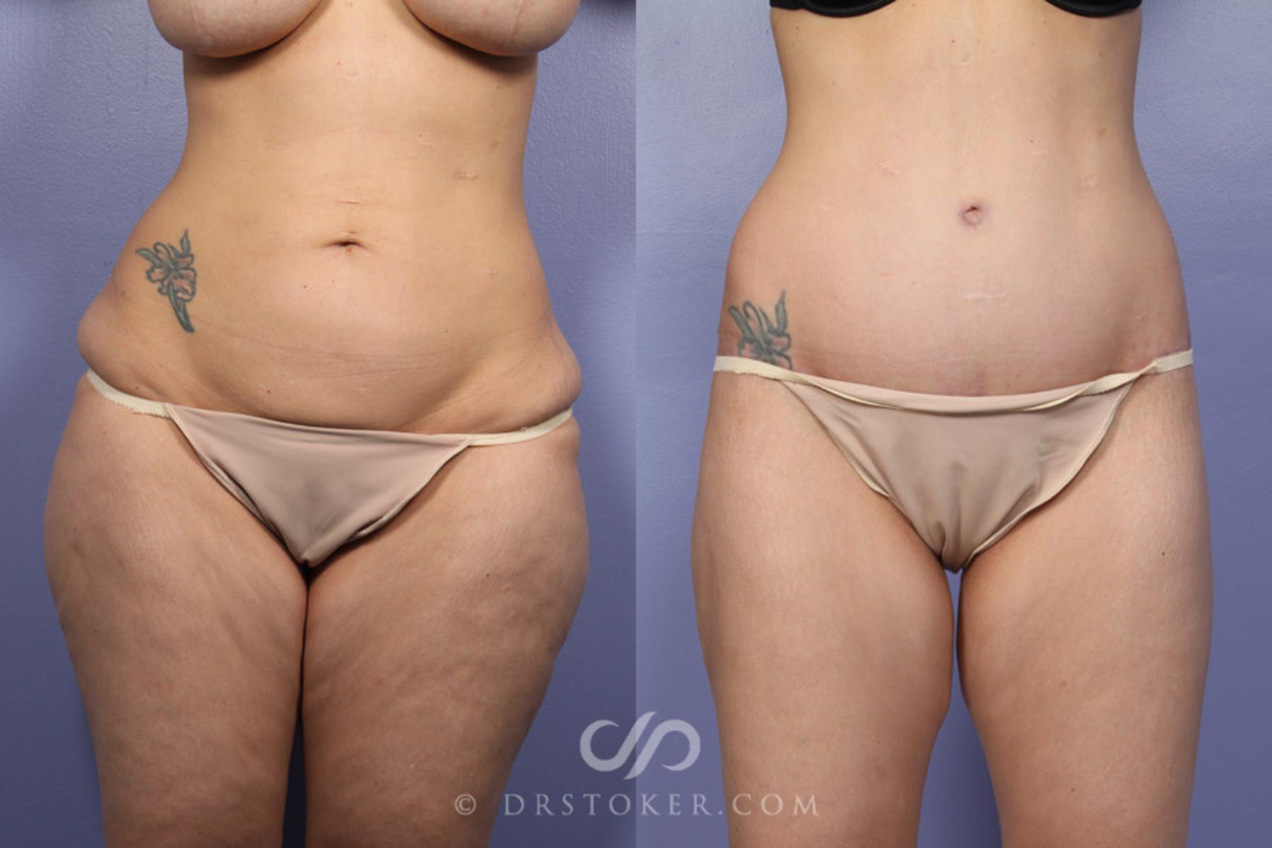 Before & After Posterior Lift Case 339 View #2 View in Los Angeles, CA