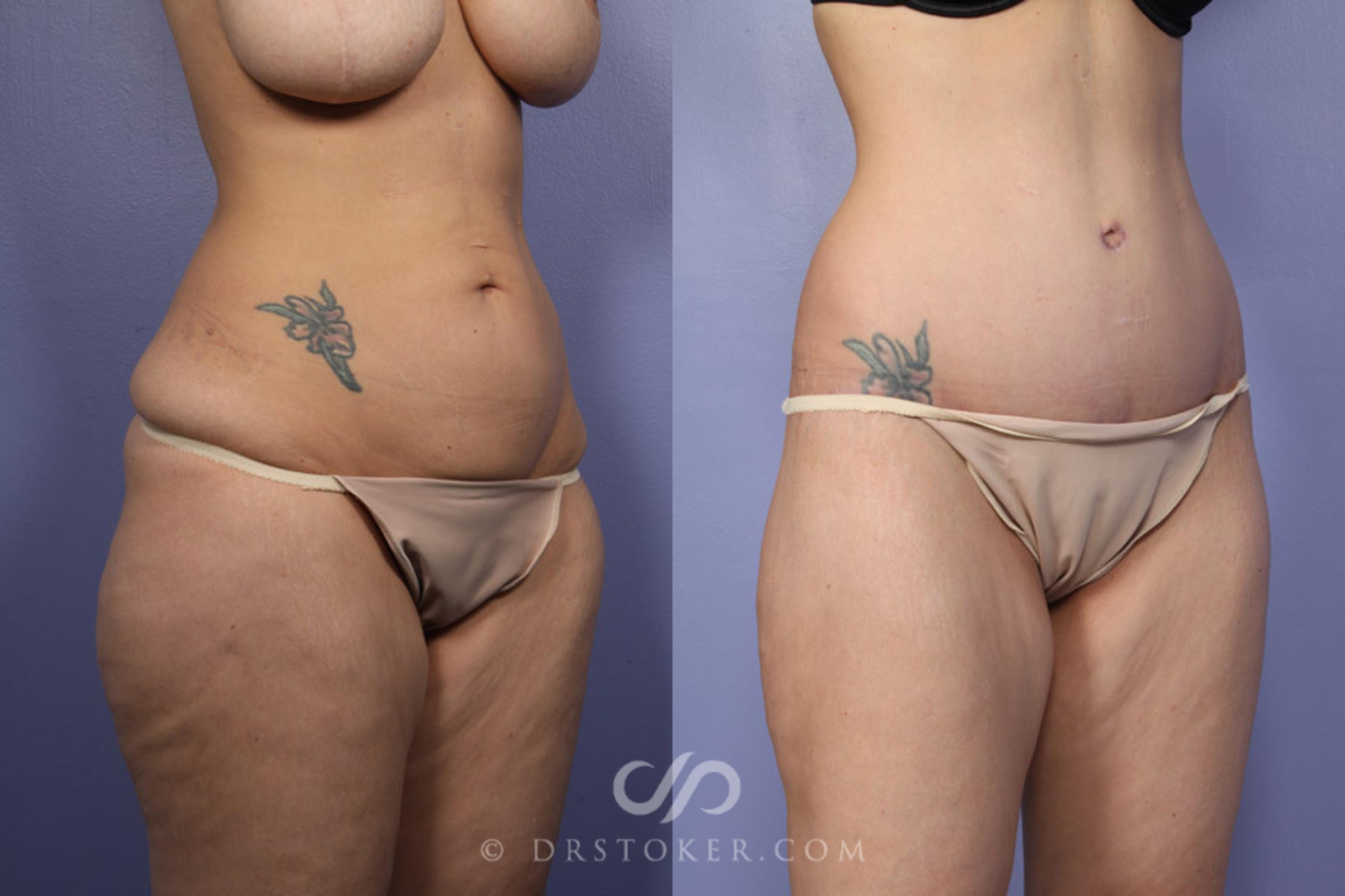 Uitrusten schedel maagd After Weight Loss Before and After Pictures Case 339 | Marina del Rey, CA |  Stoker Plastic Surgery