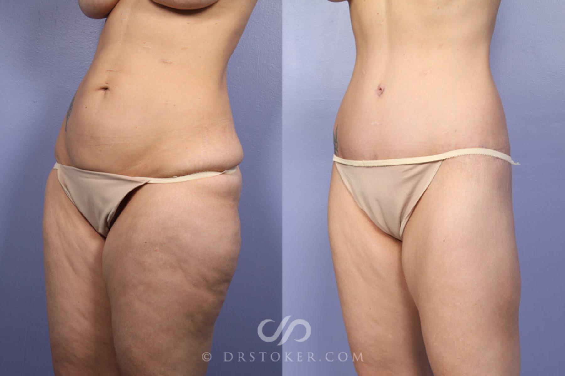 Before & After Body Lift Case 339 View #4 View in Los Angeles, CA