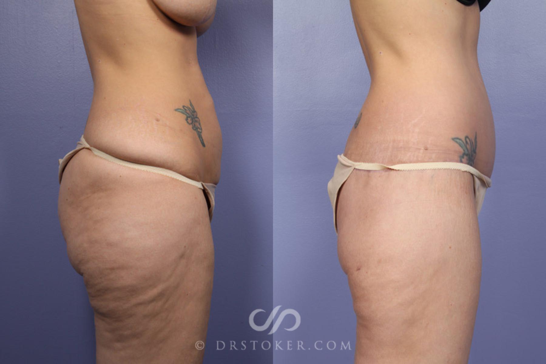 Before & After Posterior Lift Case 339 View #5 View in Los Angeles, CA