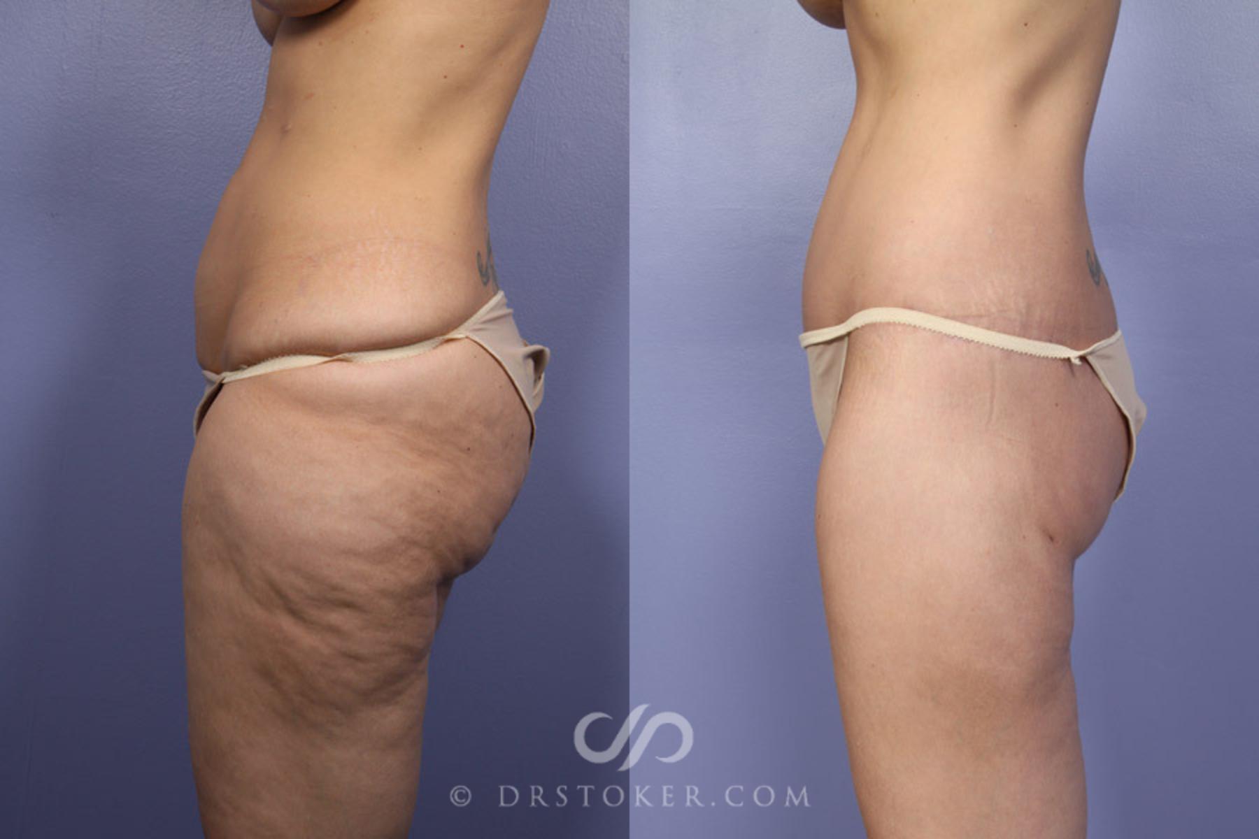 Before & After After Weight Loss Case 339 View #6 View in Los Angeles, CA