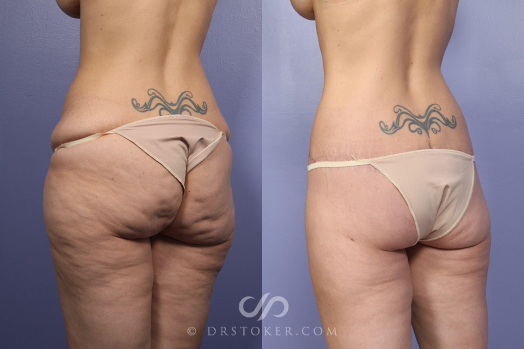 Before & After Posterior Lift Case 339 View #7 View in Los Angeles, CA