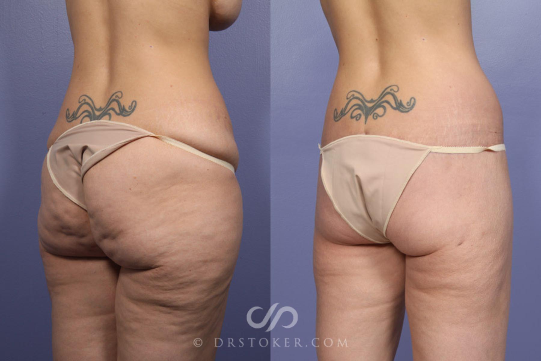 Before & After Posterior Lift Case 339 View #8 View in Los Angeles, CA