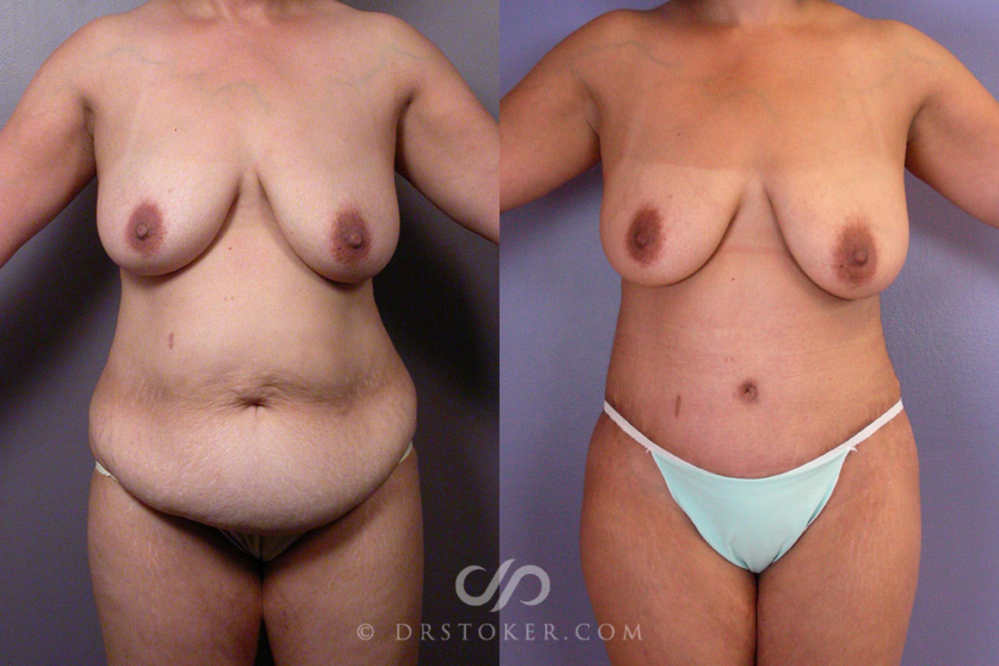 Before & After Tummy Tuck Case 354 View #1 View in Los Angeles, CA