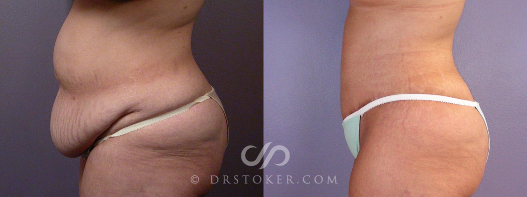 Before & After After Weight Loss Case 354 View #10 View in Los Angeles, CA